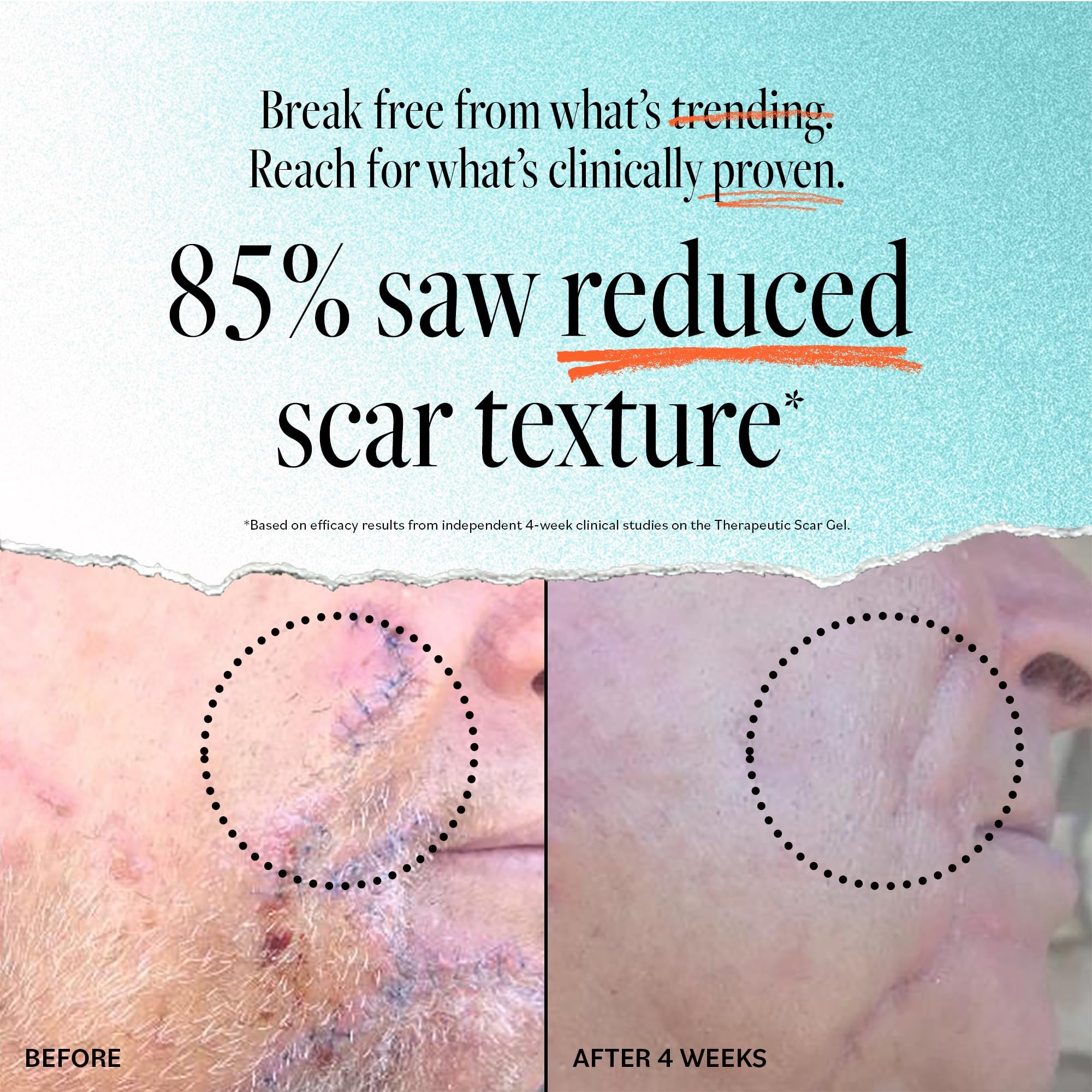 Derma E Scar Gel with Panthenol & Allantoin - Hydrating Scar Remover Gel for Acne Scars, Burns & Stretch Marks