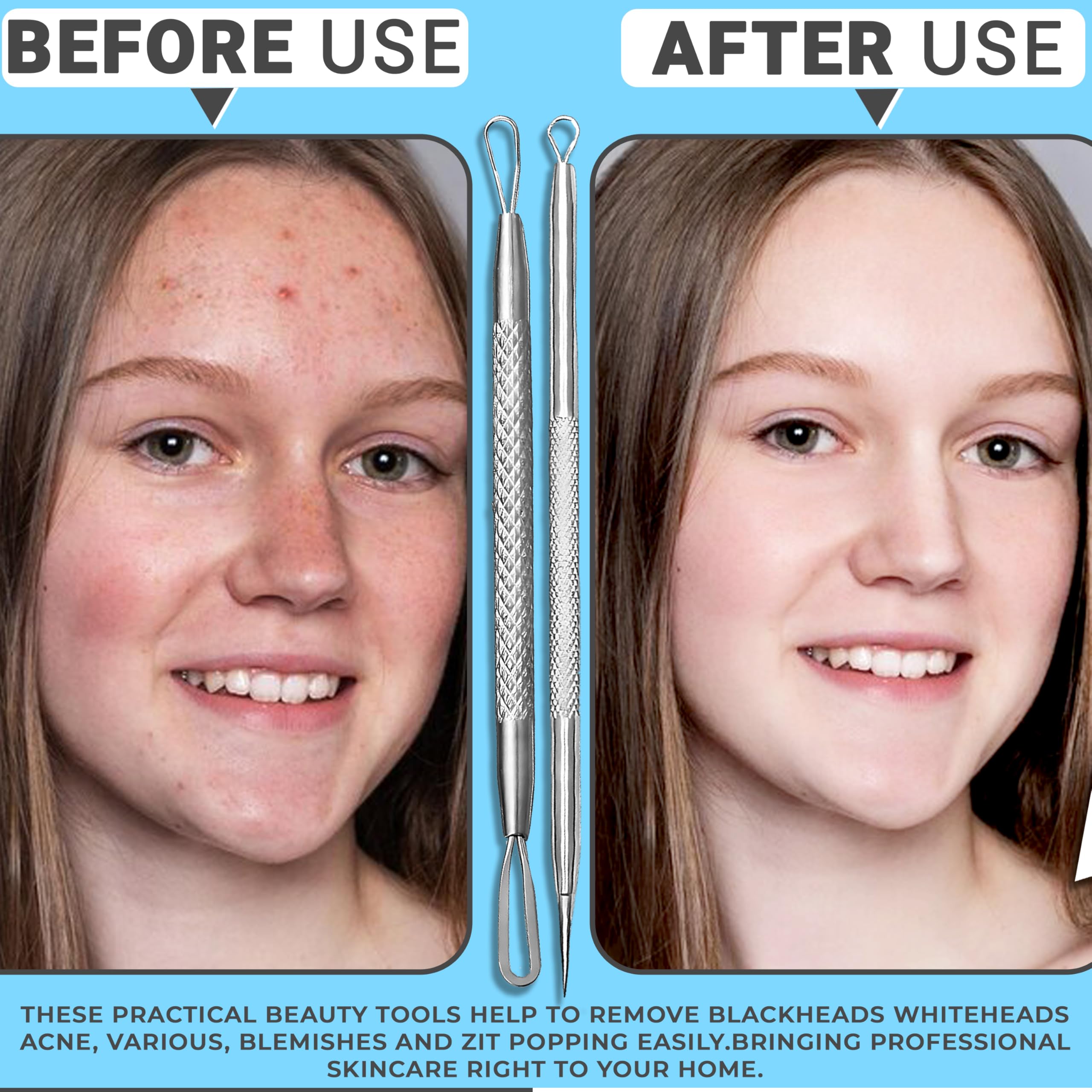 EFAH Care 2Pcs Stainless Steel Pimple Extractor Acne Treatment Tool Surgical Blemish Grade Blackhead Remover Perfect for face and Nose Easy to Clean (Silver)