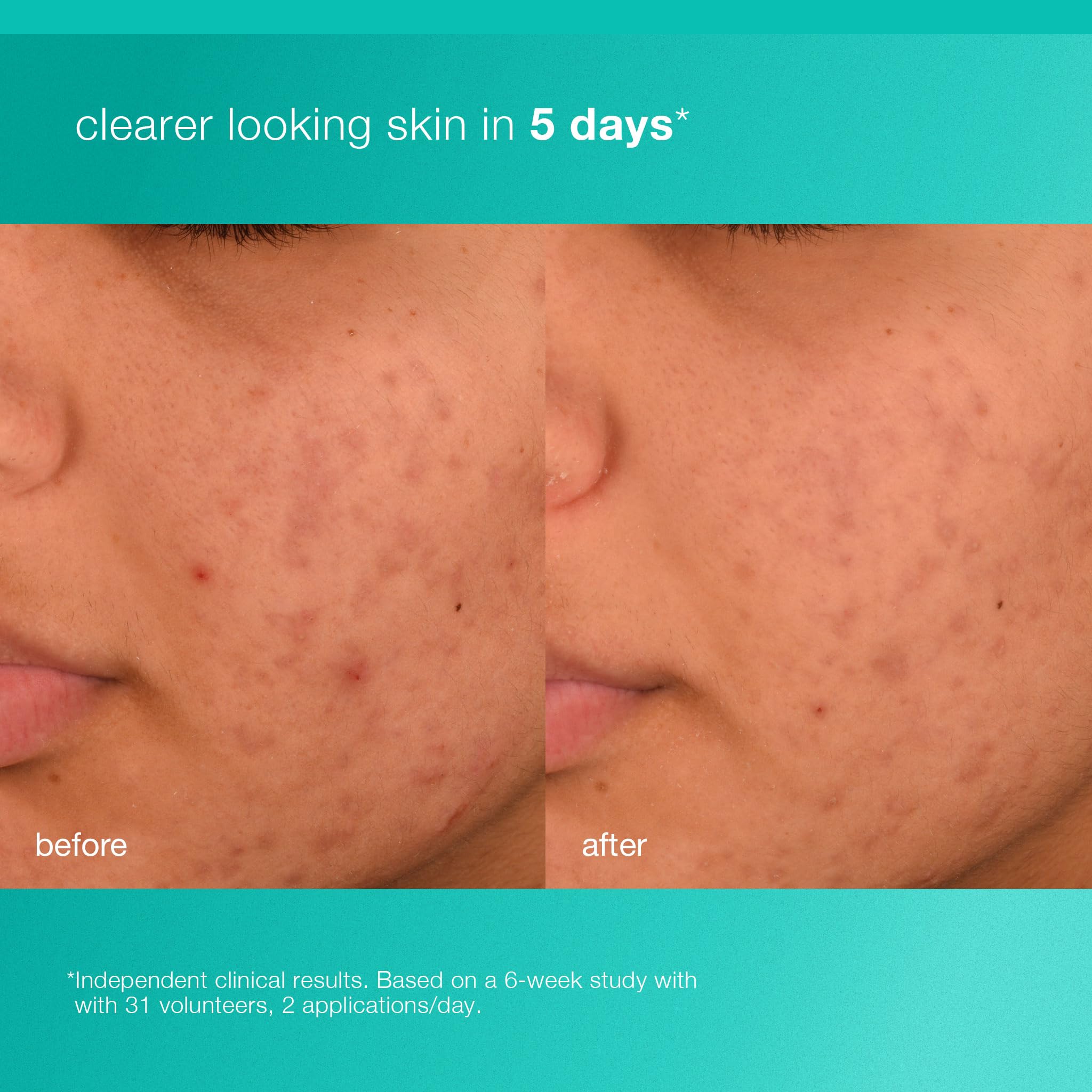 Dermalogica Acne Biotic Face Moisturizer, Lightweight Daily Lotion - Helps with Aging Skin and Prevents Breakouts, 1.7 fl oz