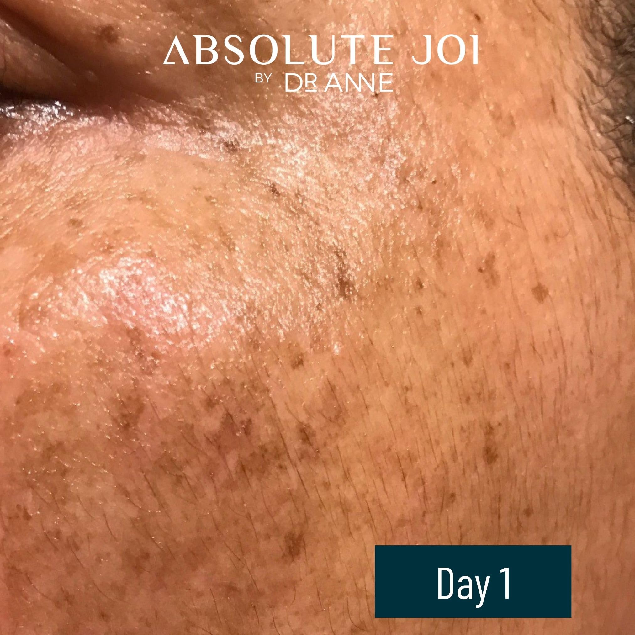 Retinol Oil Serum with Vitamin C, Skin Refining Night Oil for Fine Lines and Hyperpigmentation with Sensitive Skin Friendly Granactive Retinoid - Unscented - 0.5 Fl Oz Sample Size