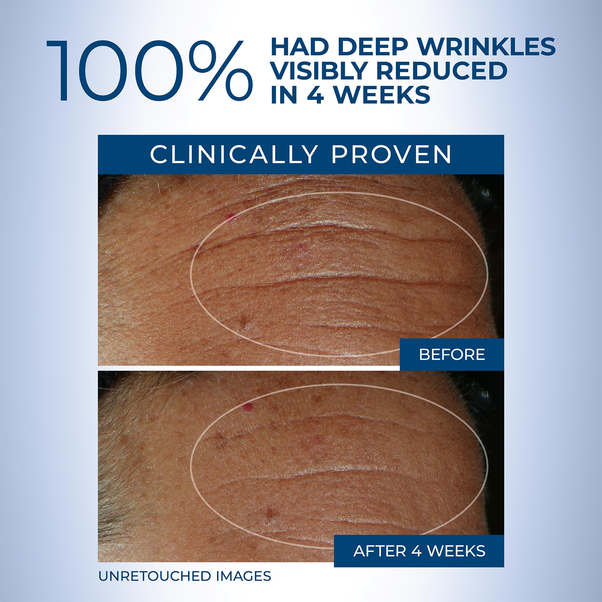 RoC Derm Correxion Fill + Treat Advanced Retinol Serum, Wrinkle Filler Treatment with Hyaluronic Acid for Crow's Feet, 11 Wrinkles, & Laugh Lines, (.5 fl oz) with Retinol Packette (Packaging May Vary)