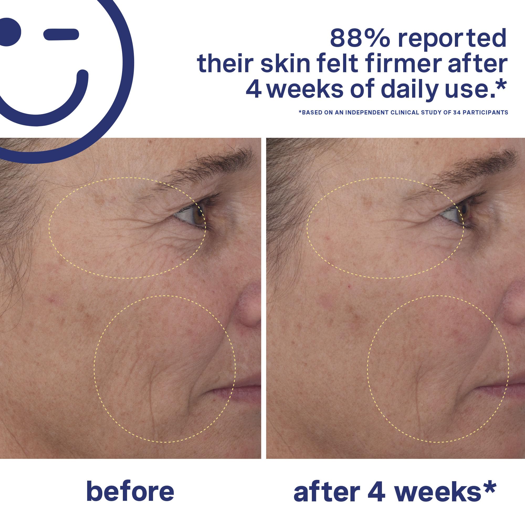 Kate Somerville Mega-A Skin Transforming, Anti-Aging Serum with Hyaluronic Acid For Uneven Texture and Wrinkles, 1 Fl. Oz