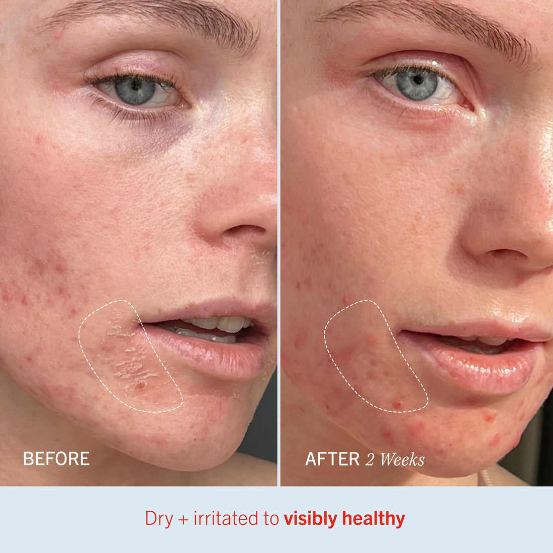 First Aid Beauty Ultra Repair Cream Intense Hydration Moisturiser for Face and Body – Rich Whipped Texture For Immediate Skin Hydration, 170.1g