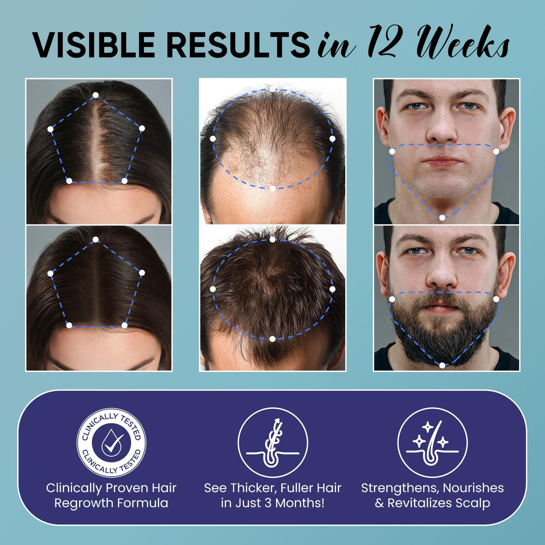 5% Minoxidil for Men and Women Hair Growth: Minoxidil Spray Hair Regrowth Treatment Serum with Biotin & Rosemary -Stop Hair Thinning and Hair Loss For Stronger Thicker Longer Hair