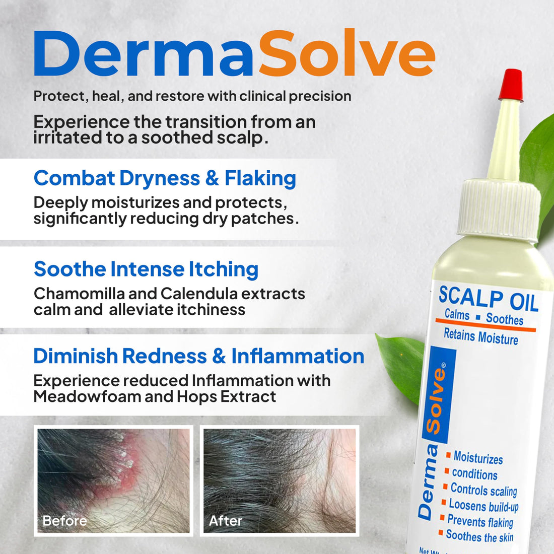 Dermasolve Psoriasis & Dandruff Scalp Oil, Dermatologist Approved for Flaky Scalp Relief