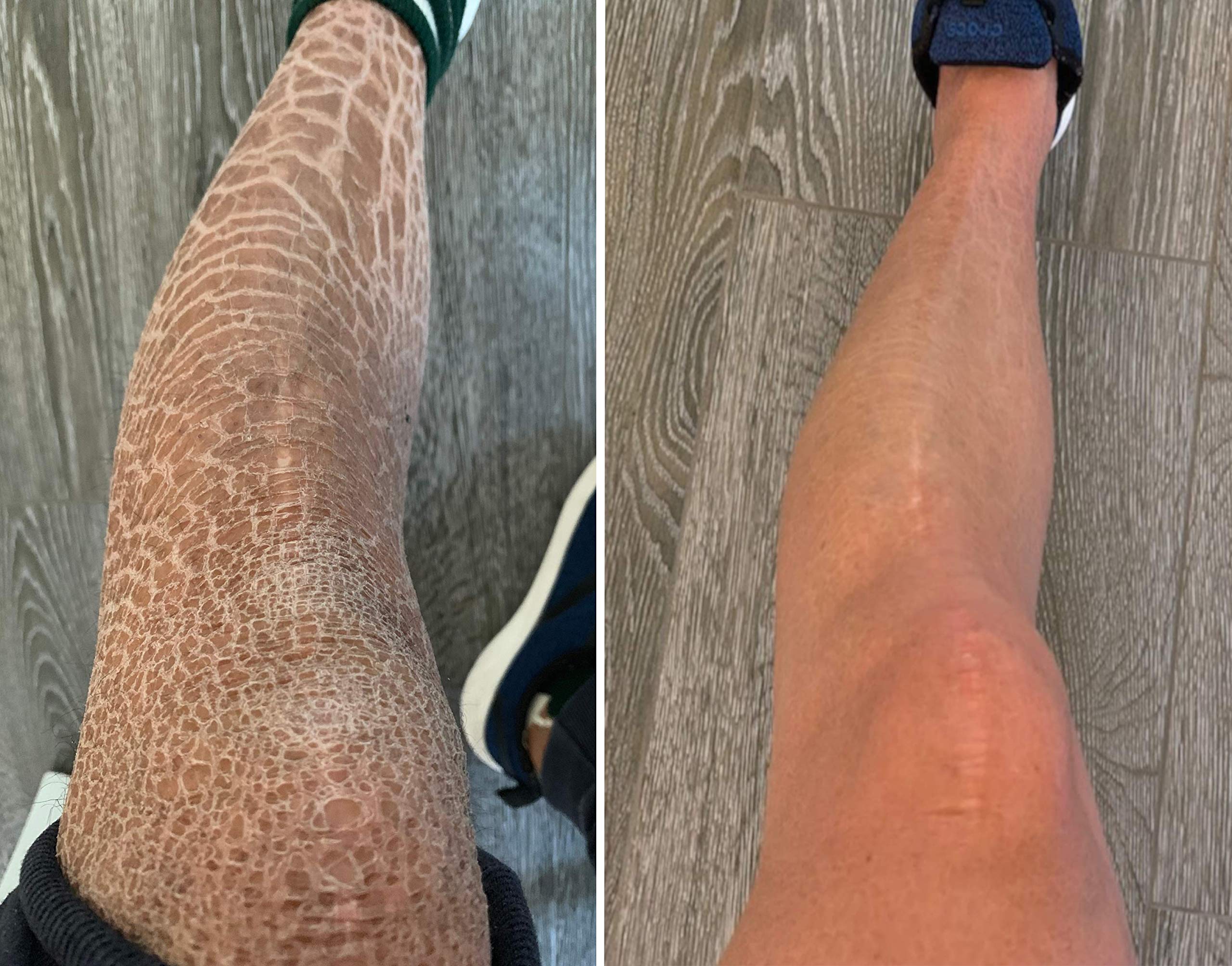 Sr Lotion, Excellent Ichthyosis Treatment, Outstanding Results In 2 Weeks