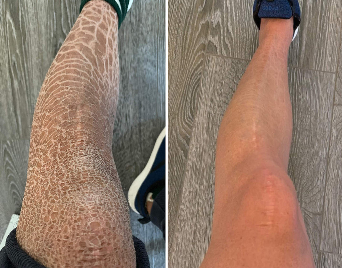 Sr Lotion, Excellent Ichthyosis Treatment, Outstanding Results In 2 Weeks