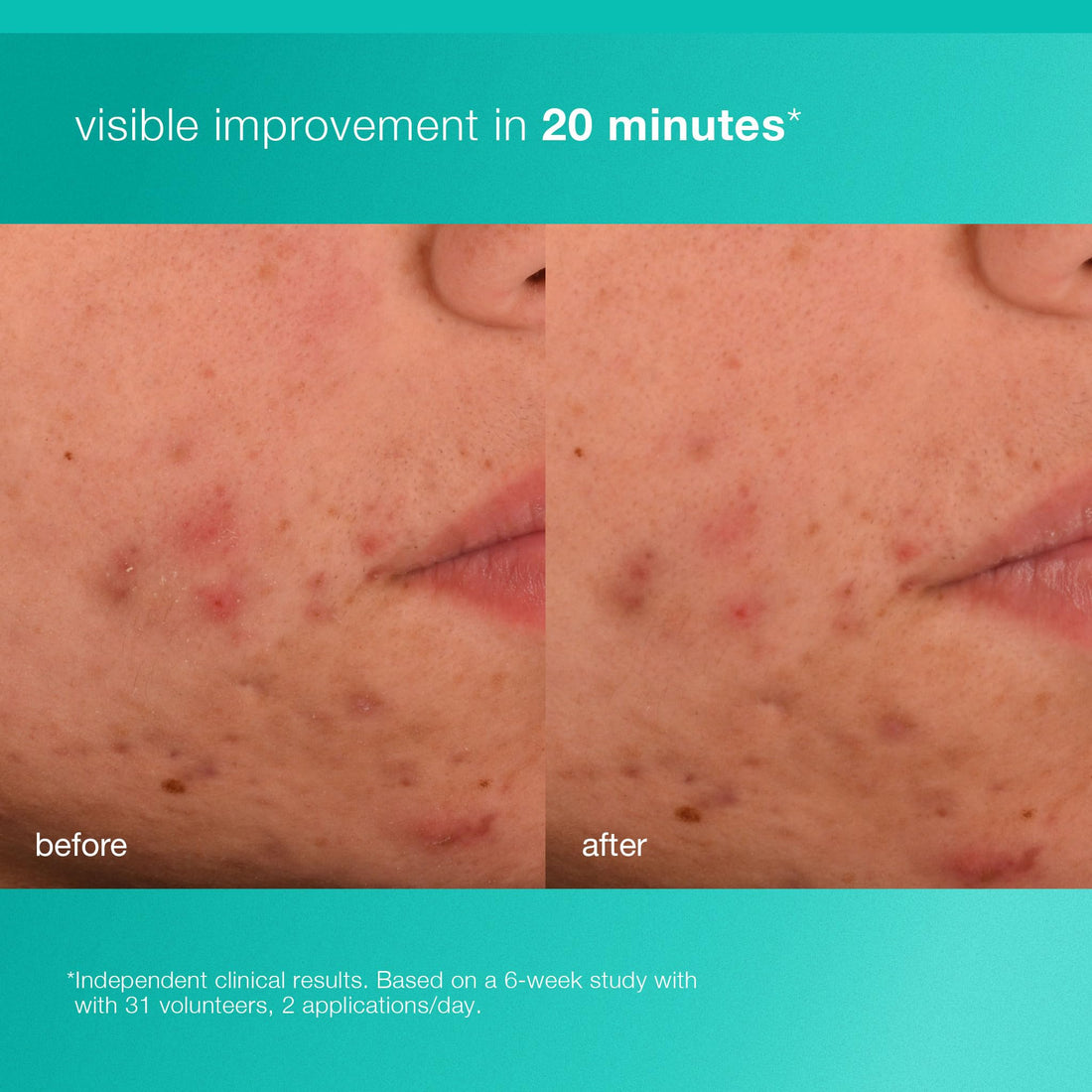 Dermalogica Acne Biotic Face Moisturizer, Lightweight Daily Lotion - Helps with Aging Skin and Prevents Breakouts, 1.7 fl oz