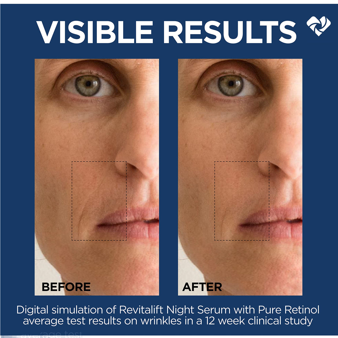 L'Oreal Paris Revitalift 0.3% Pure Retinol Night Serum, Reduce Deep Wrinkles, Fragrance Free 1 oz + Moisturizer Sample