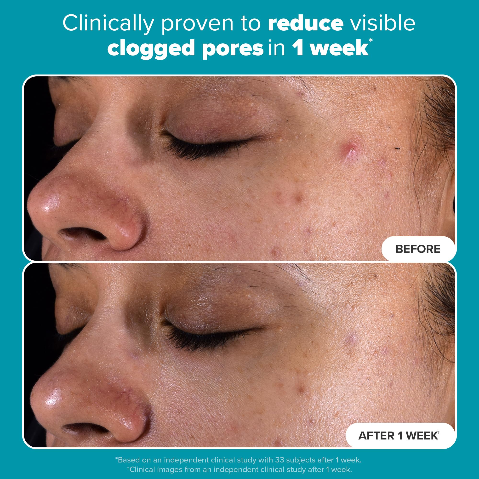 Paula's Choice Skin Perfecting 2% BHA Liquid Salicylic Acid Exfoliant, Gentle Facial Exfoliator for Blackheads, Large Pores, Wrinkles & Fine Lines, Travel Size, 1 Fluid Ounce