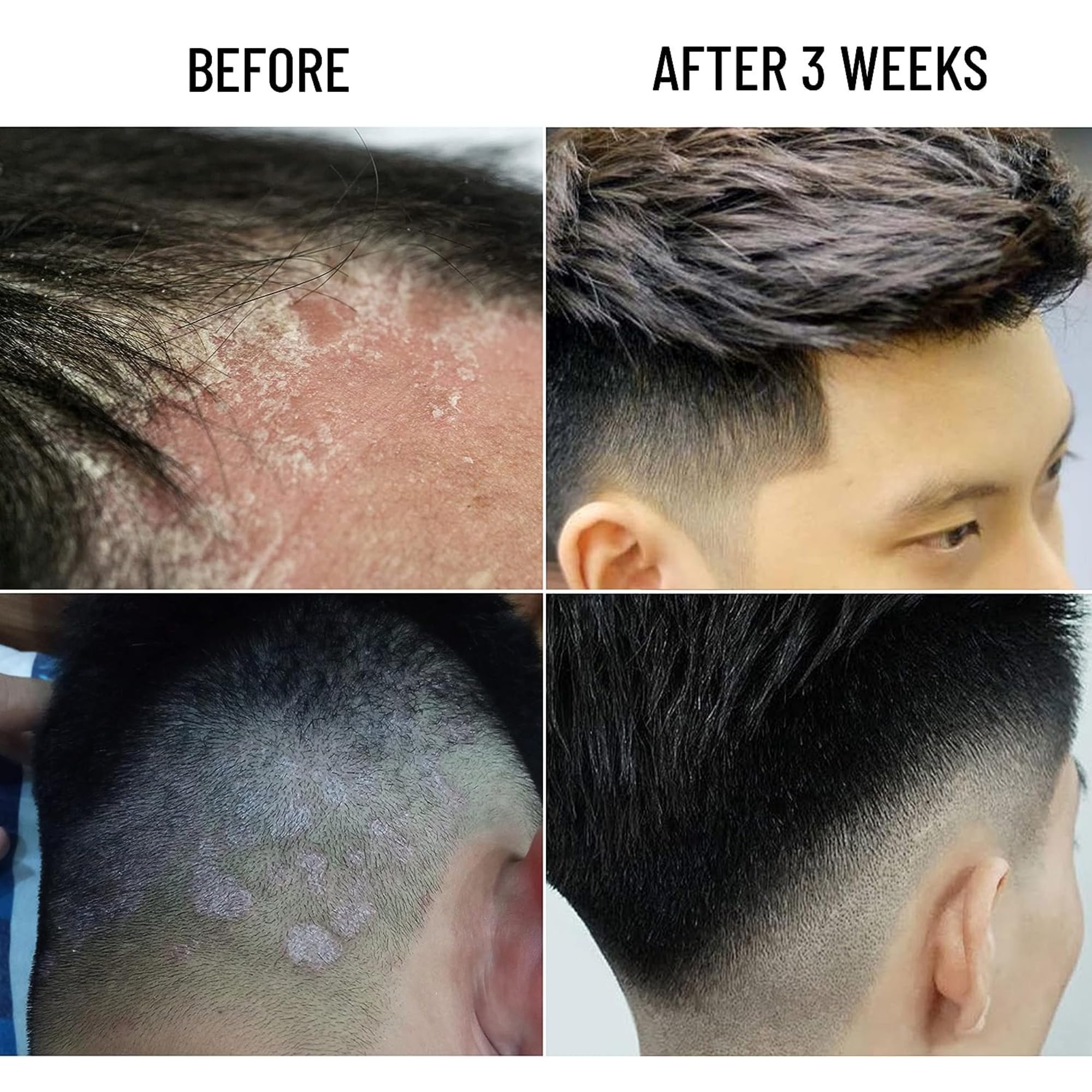 ABERA Amanda Anti-Dandruff Shampoo for Stronger Hair & Healthier Scalp, Nourishes, Get Rid of Dandruff