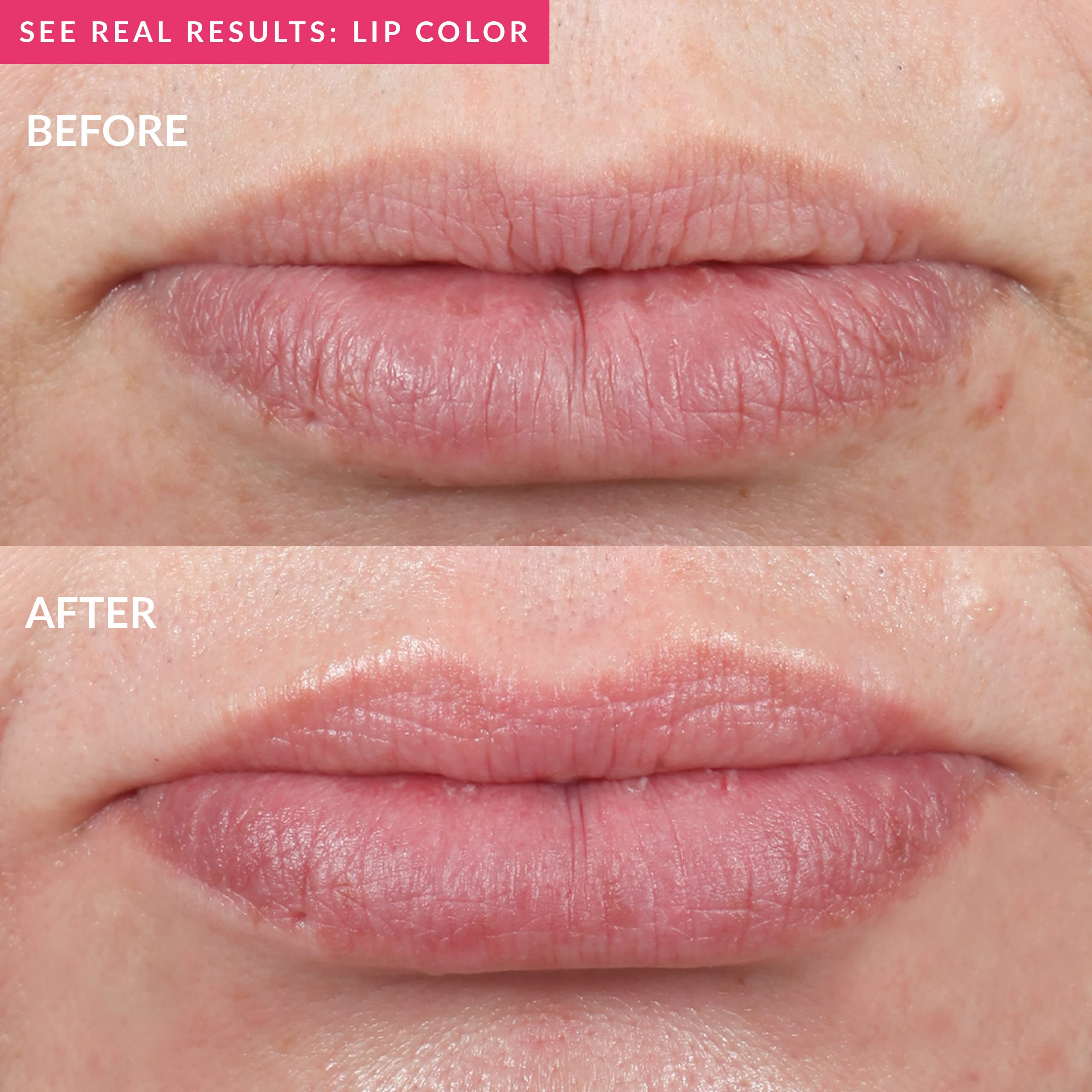 PMD Kiss Lip Plumping System - Smart Anti-Aging Lip Plumping Treatment - Pulsating Vacuum Technology for Fuller, More Youthful Lips