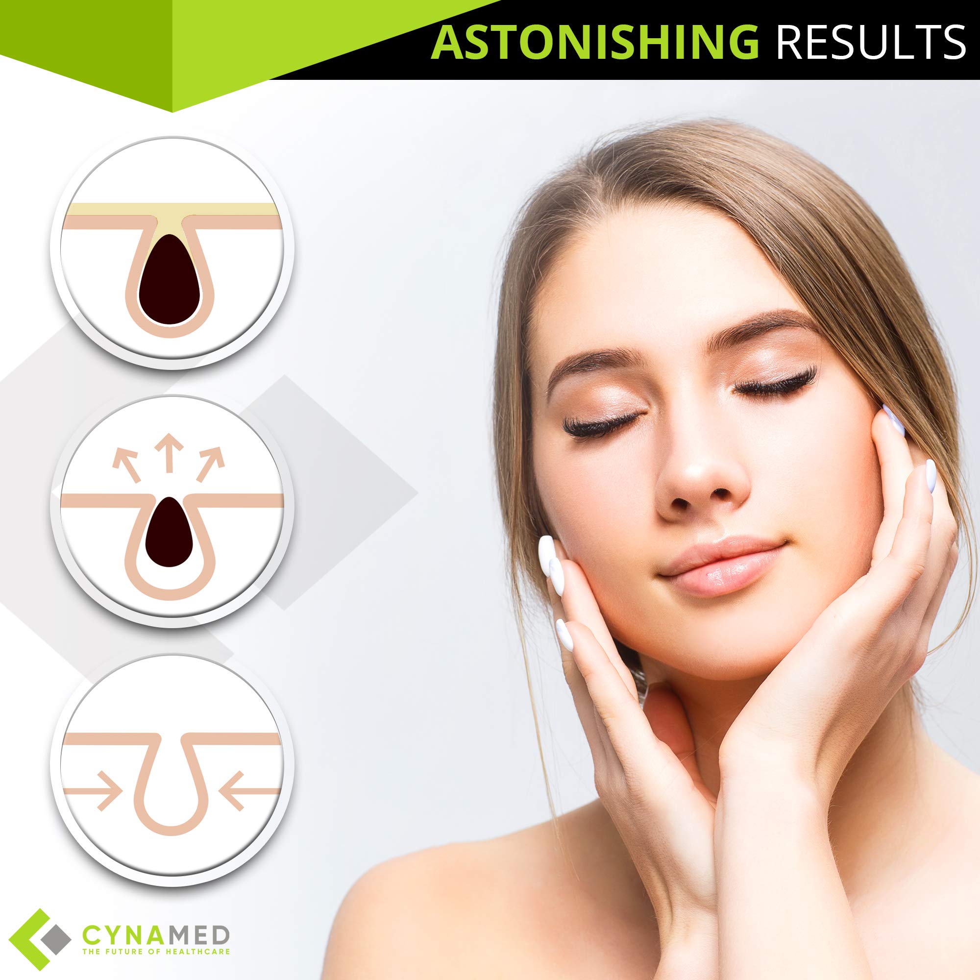 Blackhead Tweezer - Professional Curved Steel Tip Surgical Comedone & Splinter Extractor. Ideal Blemish & Acne Remover Tool Means Flawless Facial Skin (Red)