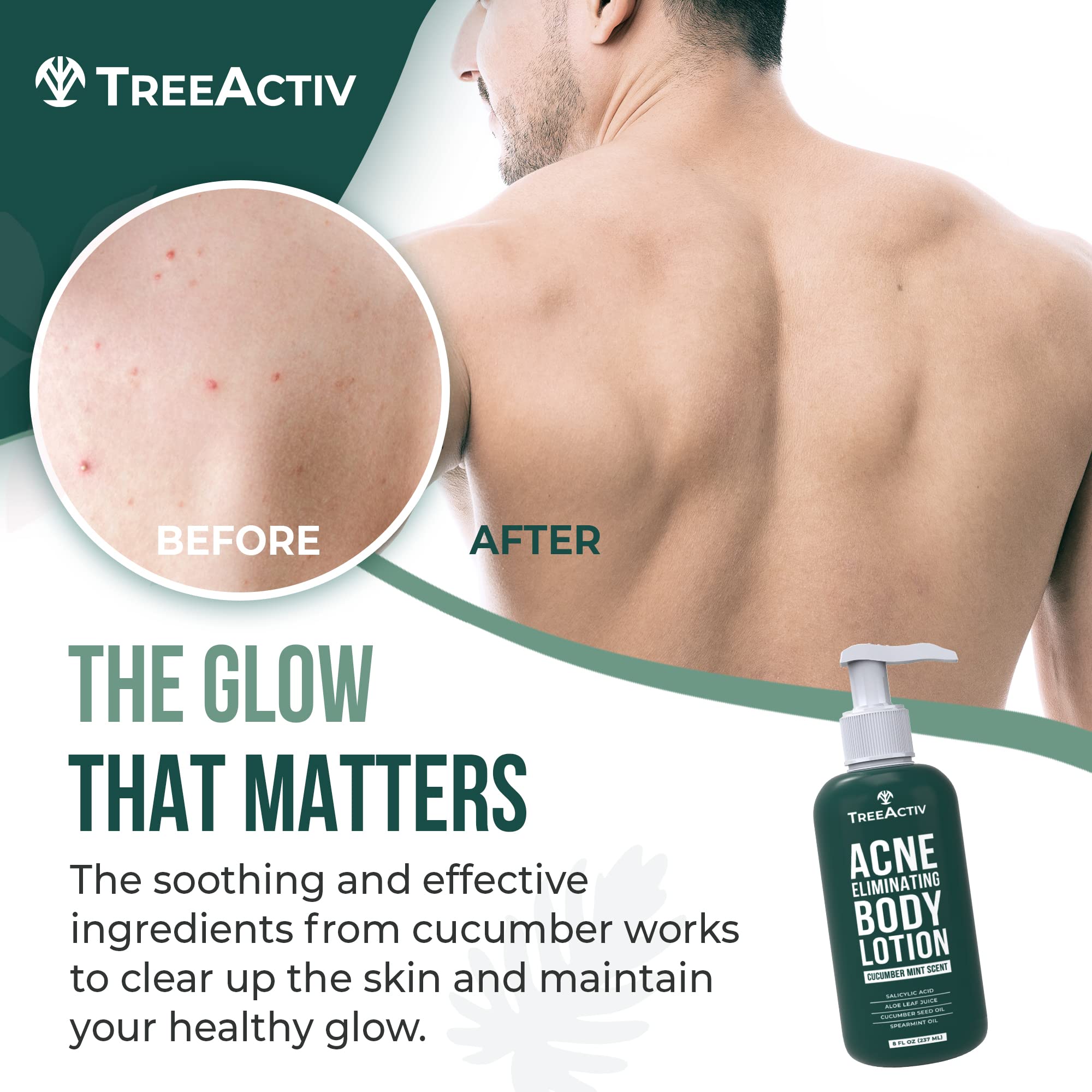 TreeActiv Acne Eliminating Body Lotion 8 fl oz | Clears Body, Back, Butt and Shoulder Acne | Anti-Acne Moisturizer | Prevents Future Breakouts | Cucumber Mint Scent