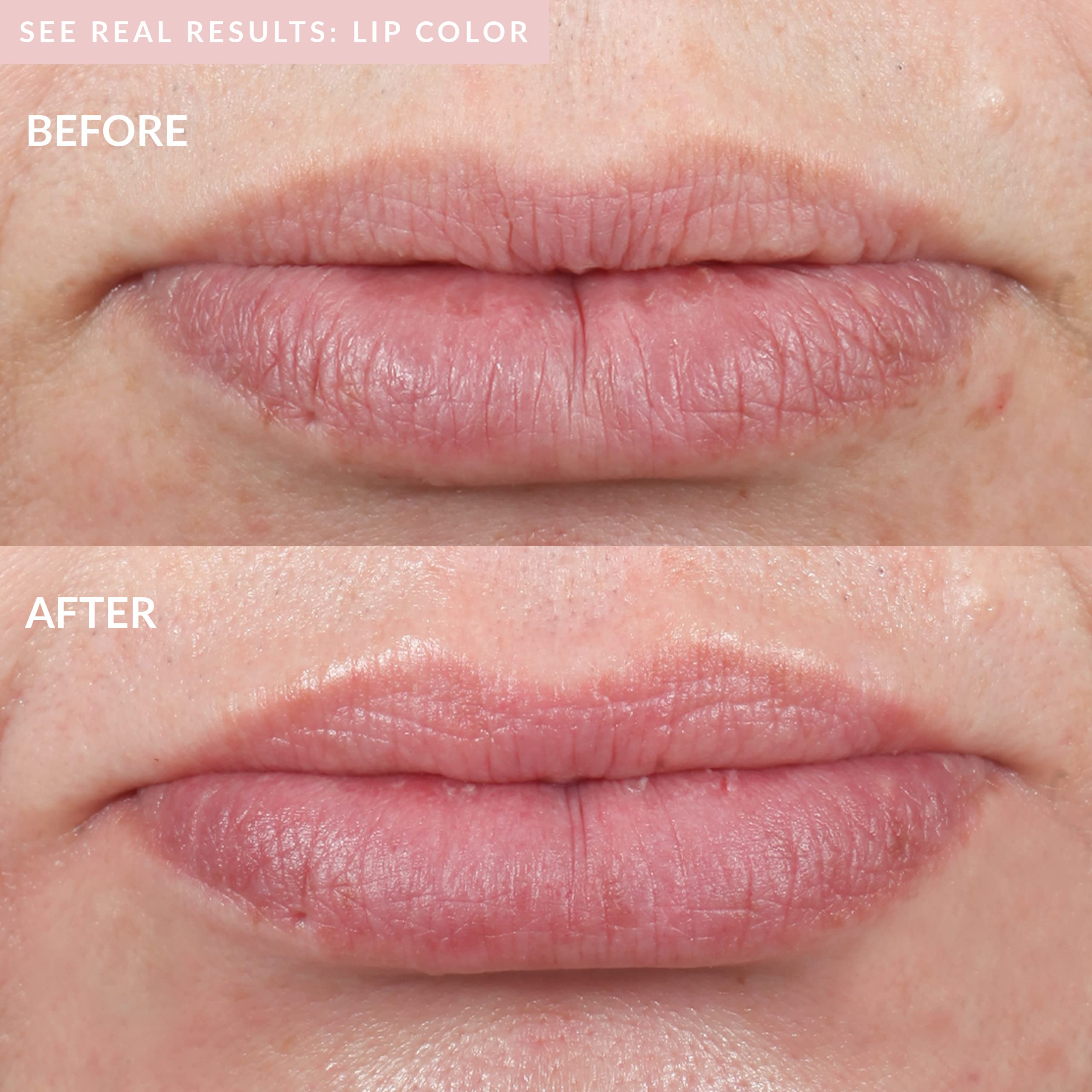 PMD Kiss Lip Plumping System - Smart Anti-Aging Lip Plumping Treatment - Pulsating Vacuum Technology for Fuller, More Youthful Lips