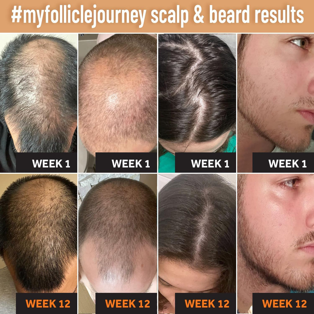 Biotin Hair Growth Shampoo and Conditioner Set for Men and Women - Thickening Treatment for Thinning Hair - Natural and Vegan DHT Blocker for Hair Loss - Caffeine, Saw Palmetto, Niacin, Argan Oil