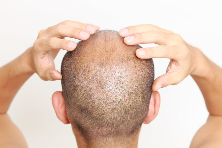 Ooh! Dry Itchy Scalp Relief - An All Natural, Vegan-friendly Soothing Treatment Oil for Men & Women Who Suffer From Dandruff, a Dry Itchy, or Seborrheic Scalp and Want Soothing Relief and a Healthier Scalp. This Fast Absorbing Non-greasy Oil Is Ide