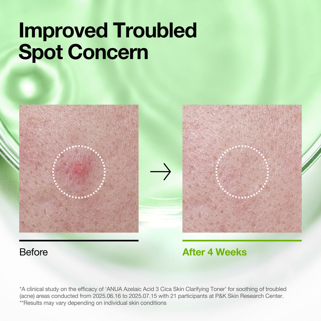 Anua Azelaic Acid 3 CICA Skin Claryfing Toner, Soothing & Clear Care, with Salicylic Acid & Azelaic Acid, Sebum & Spot Care, Suitable for Sensitive Skin, Korean Skin Care (250ml / 8.45 fl.oz.)