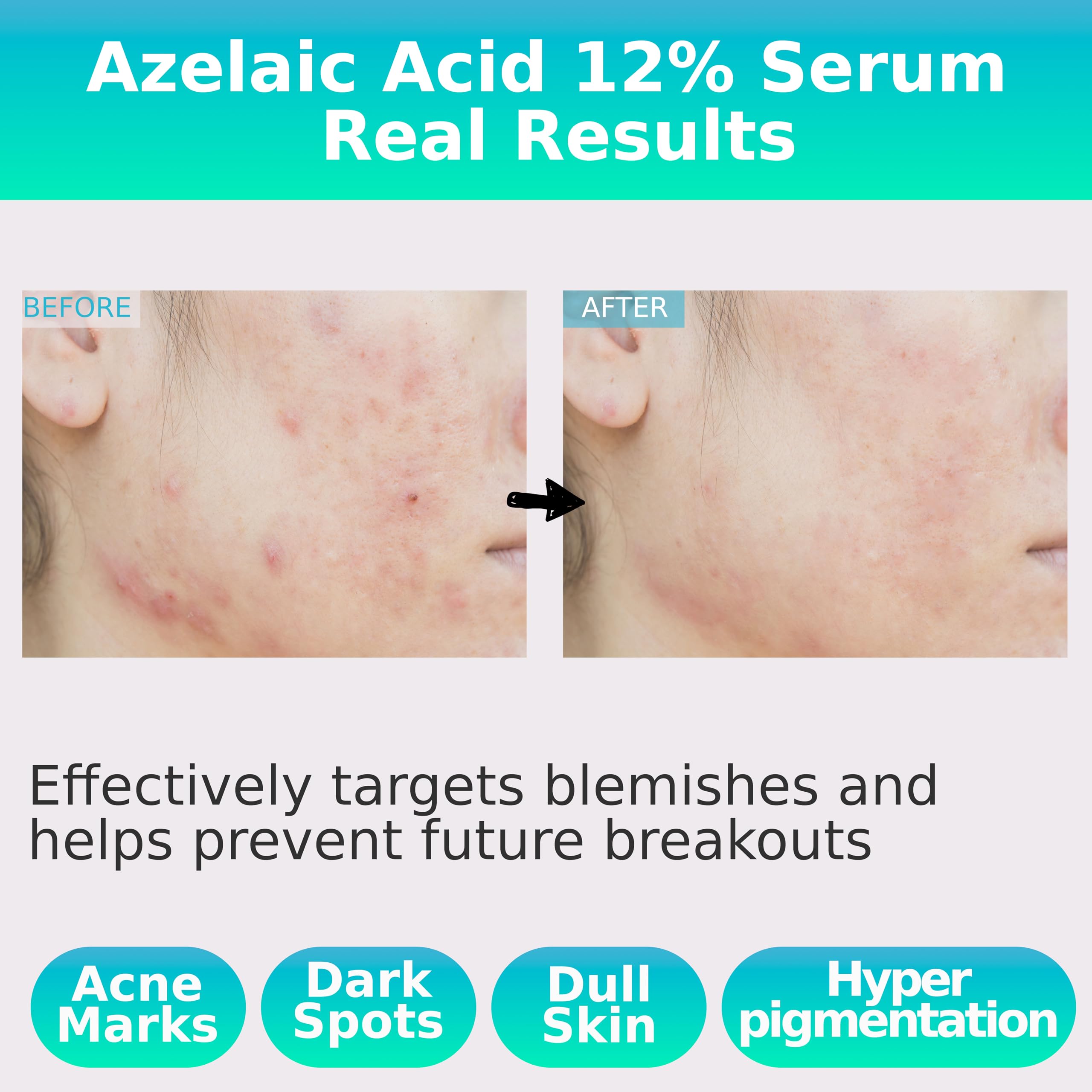 Azelaic Acid 12% Facial Serum w/Niacinamide – Rapid Relief for Rosacea, Reduces Cystic Acne Scars & Pigmentation, Soothes Redness, Pimples, & Blackheads – for Sensitive Skin Korean Skincare