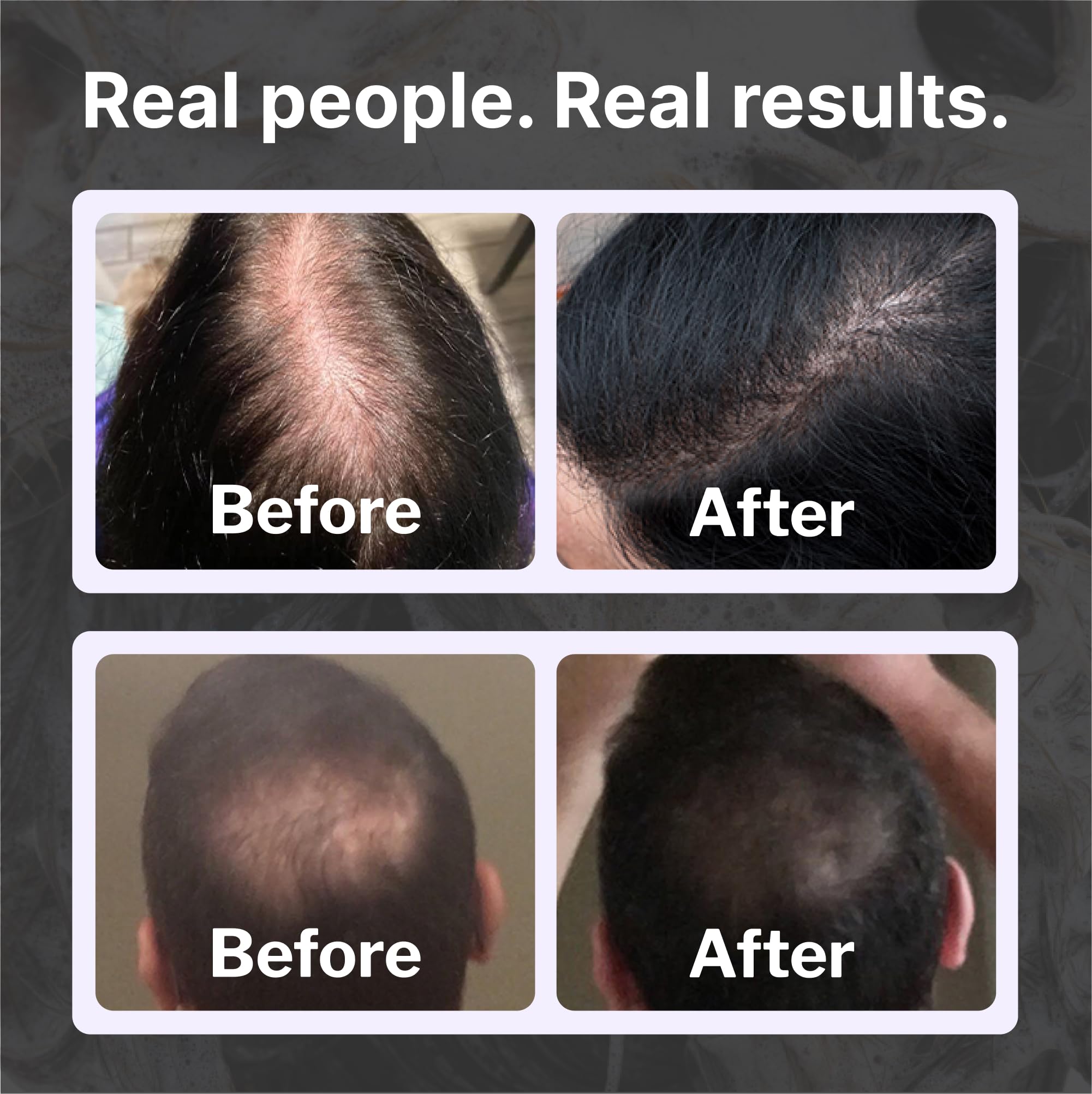 Shapiro MD Shampoo Containing the 3 Most Powerful, All-Natural DHT Blockers for Thicker, Fuller, and Healthier Hair (1 Month Supply) (Shampoo)