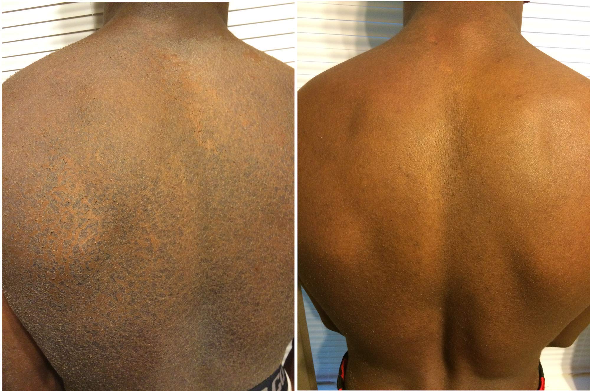 Sr Lotion, Excellent Ichthyosis Treatment, Outstanding Results In 2 Weeks