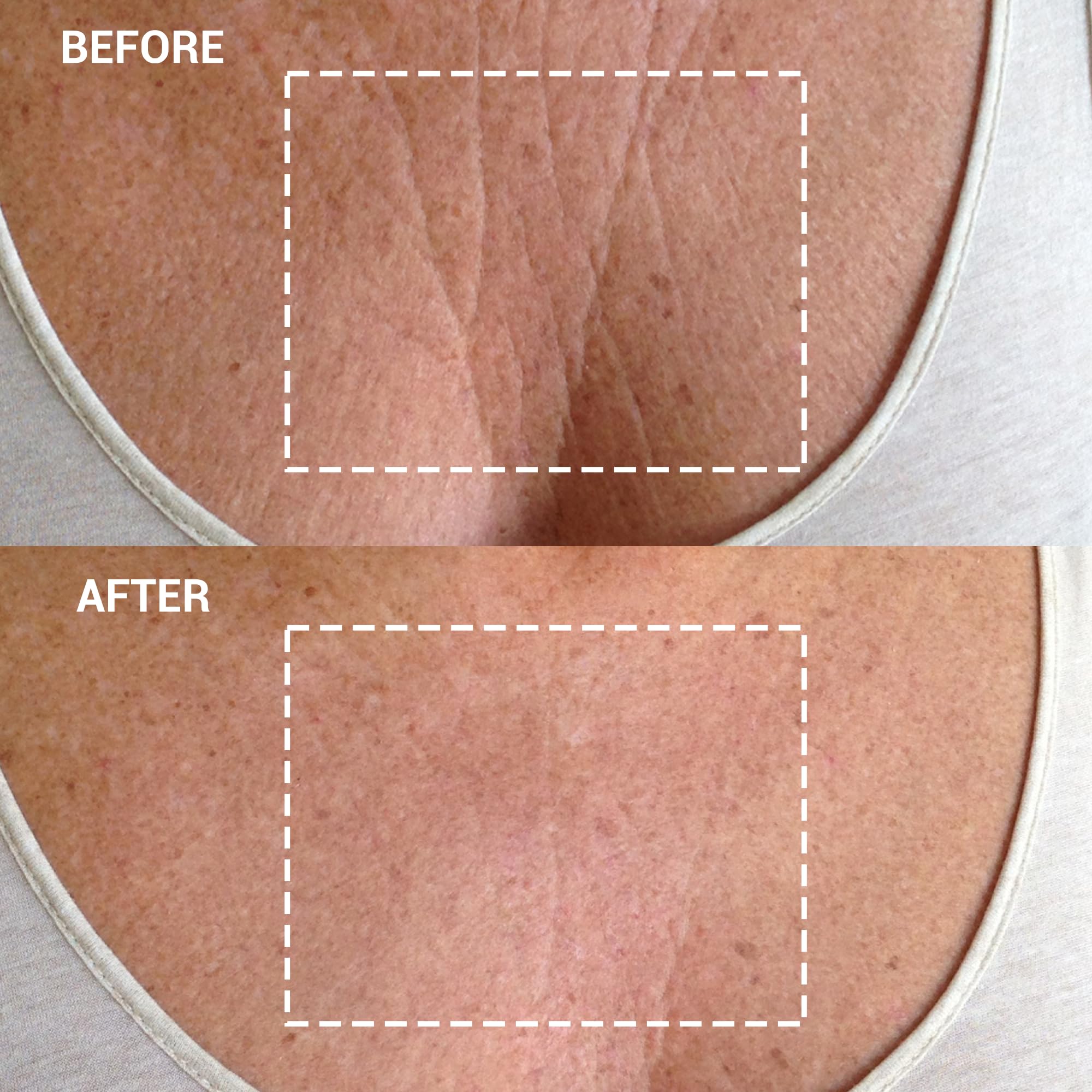Wrinkles Schminkles Chest Wrinkles & Décolletage Wrinkles - Chest Smoothing Kit