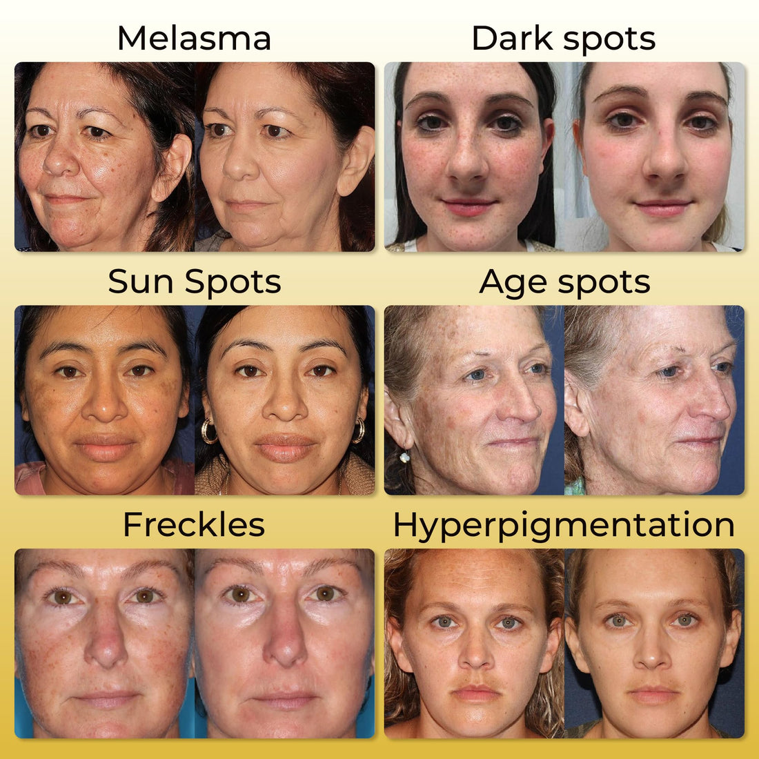 ABERA Kasumi Melasma Cream, Dark Spot Remover For Face, Reduce Fine Lines, Wrinkles, Anti-aging with Red Ginseng Extract, Facial Moisturizer For Women (0.7 Oz Per Box)