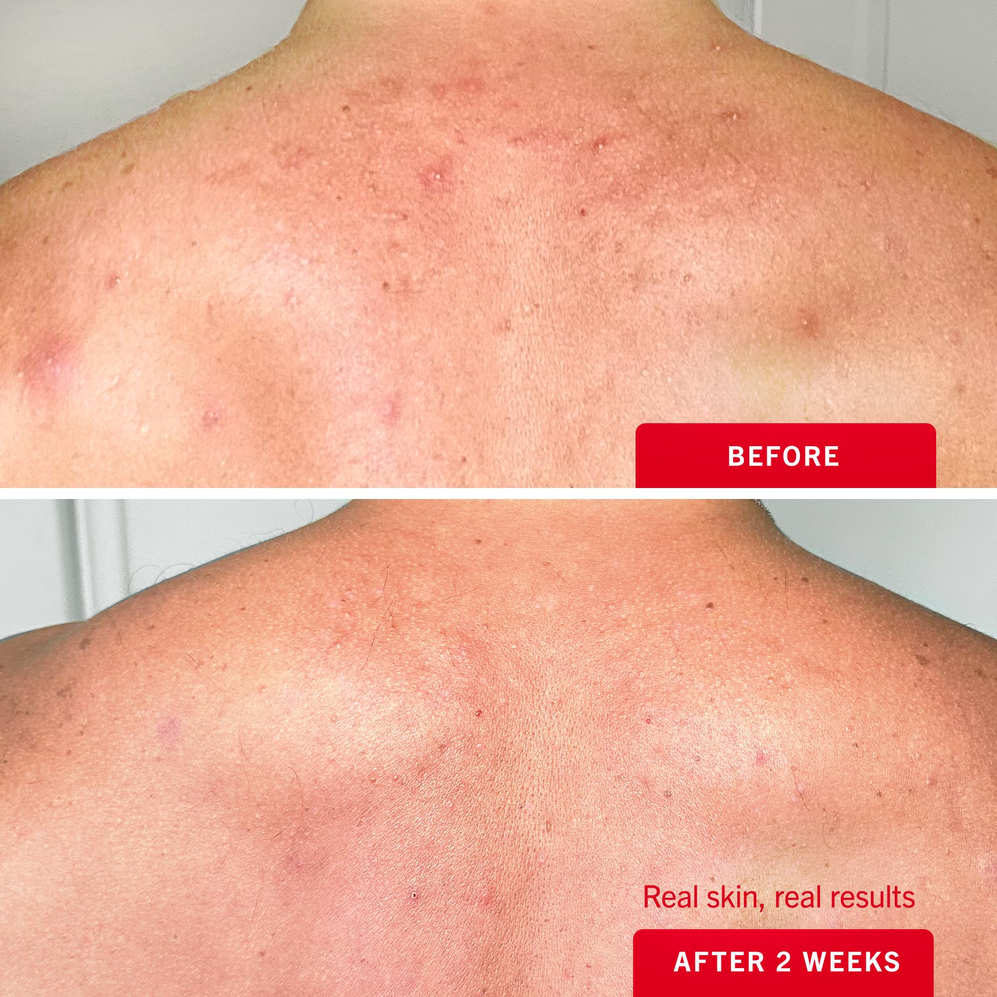 First Aid Beauty Body Acne Spray - Maximum Strength Body Acne Treatment With 360-Degree Sprayer - 2% Salicylic Acid Formula, (3.0 oz)