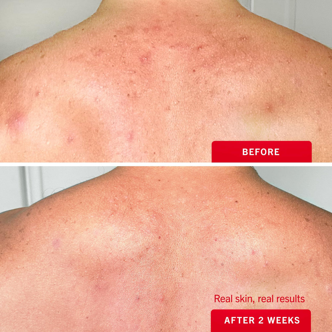 First Aid Beauty Body Acne Spray - Maximum Strength Body Acne Treatment With 360-Degree Sprayer - 2% Salicylic Acid Formula, (3.0 oz)