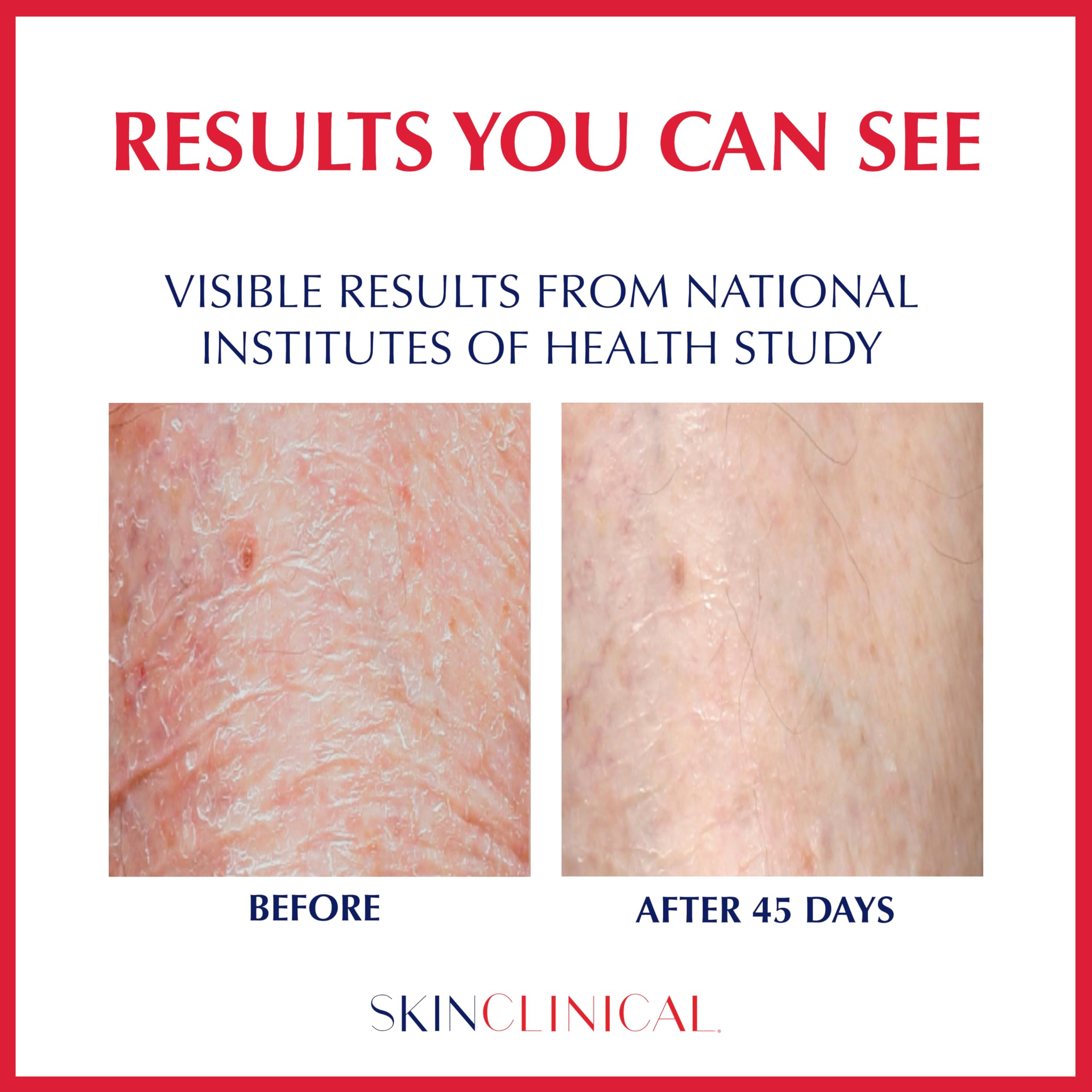 SkinClinical Extreme Healing, Non-Sticky, Fast-Absorbing Lotion For Dry Skin with Eczema and Psoriasis, Fragrance Free Lotion with Patented Ingredient SBD-4, Soothing Relief for Hand and Body, 3 Oz