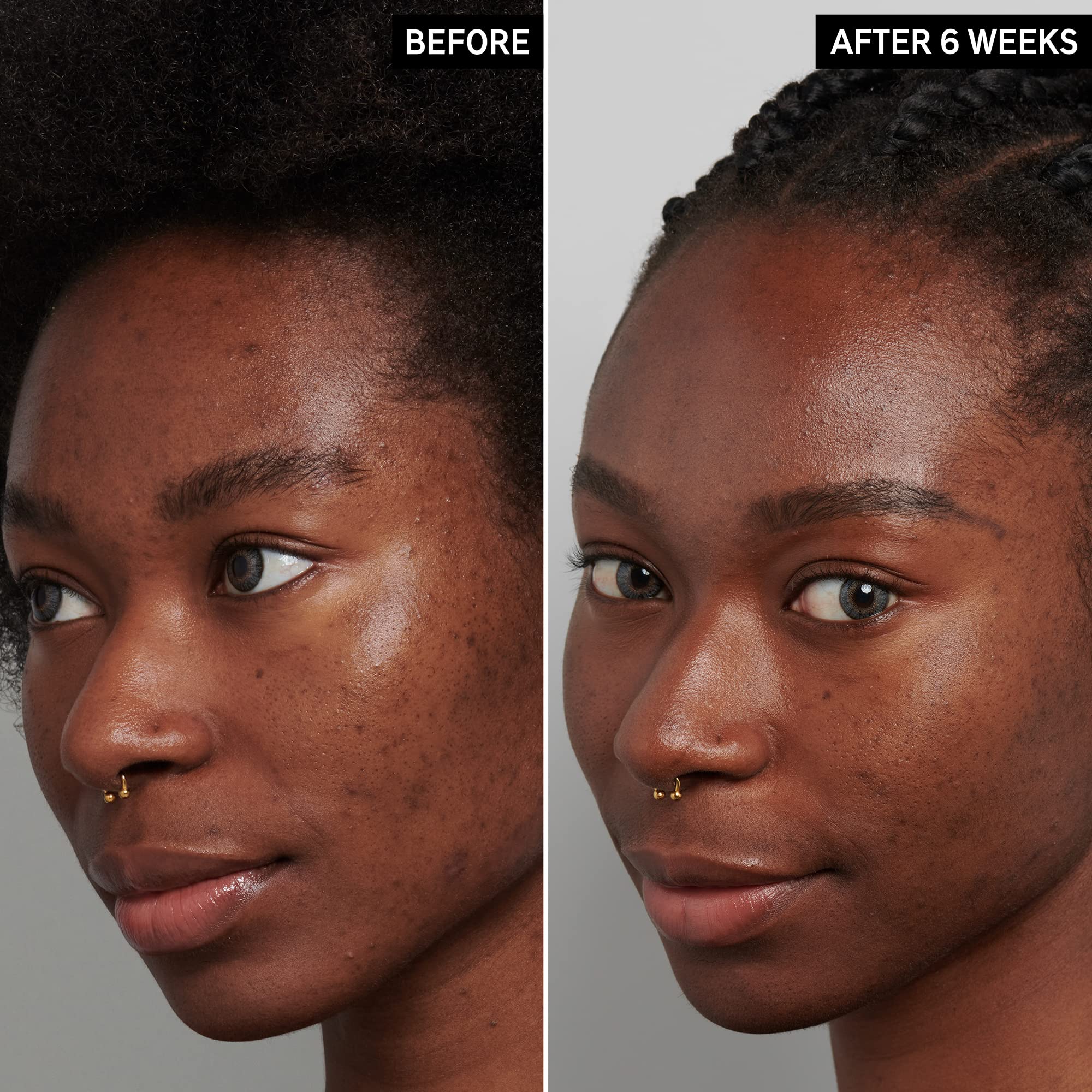 The INKEY List Tranexamic Acid Serum, Helps Reduce Appearance of Skin Discoloration, Dark Spots and Uneven Patches, Healthy-Looking Skin Tone, 1 fl oz