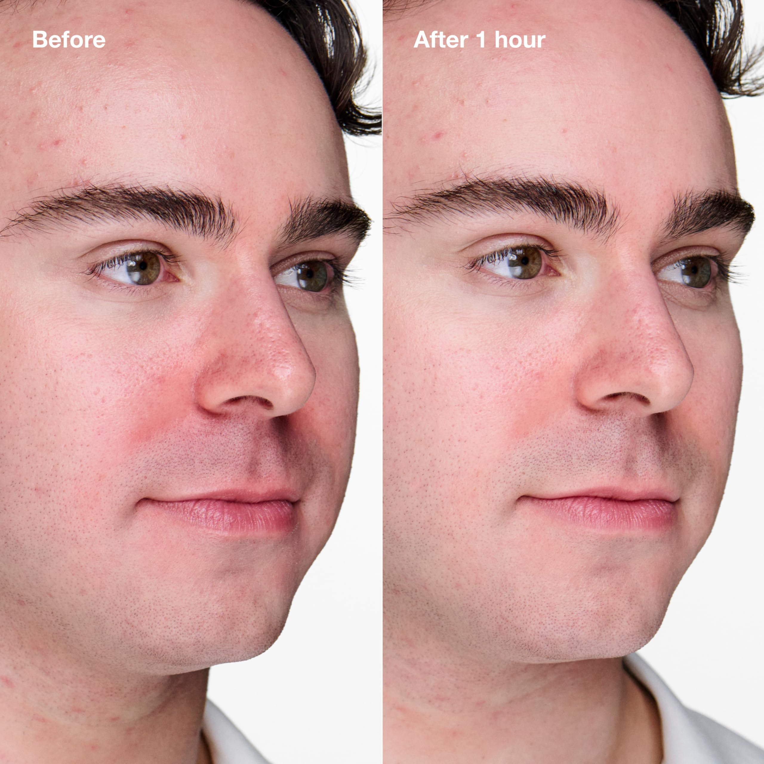 Clinique Acne Solutions Clinical Clearing Gel Acne Treatment With Witch Hazel + Salicylic Acid For Very Dry to Oily Skin Types | Oil-Free | Soothing, 0.68 Fl Oz