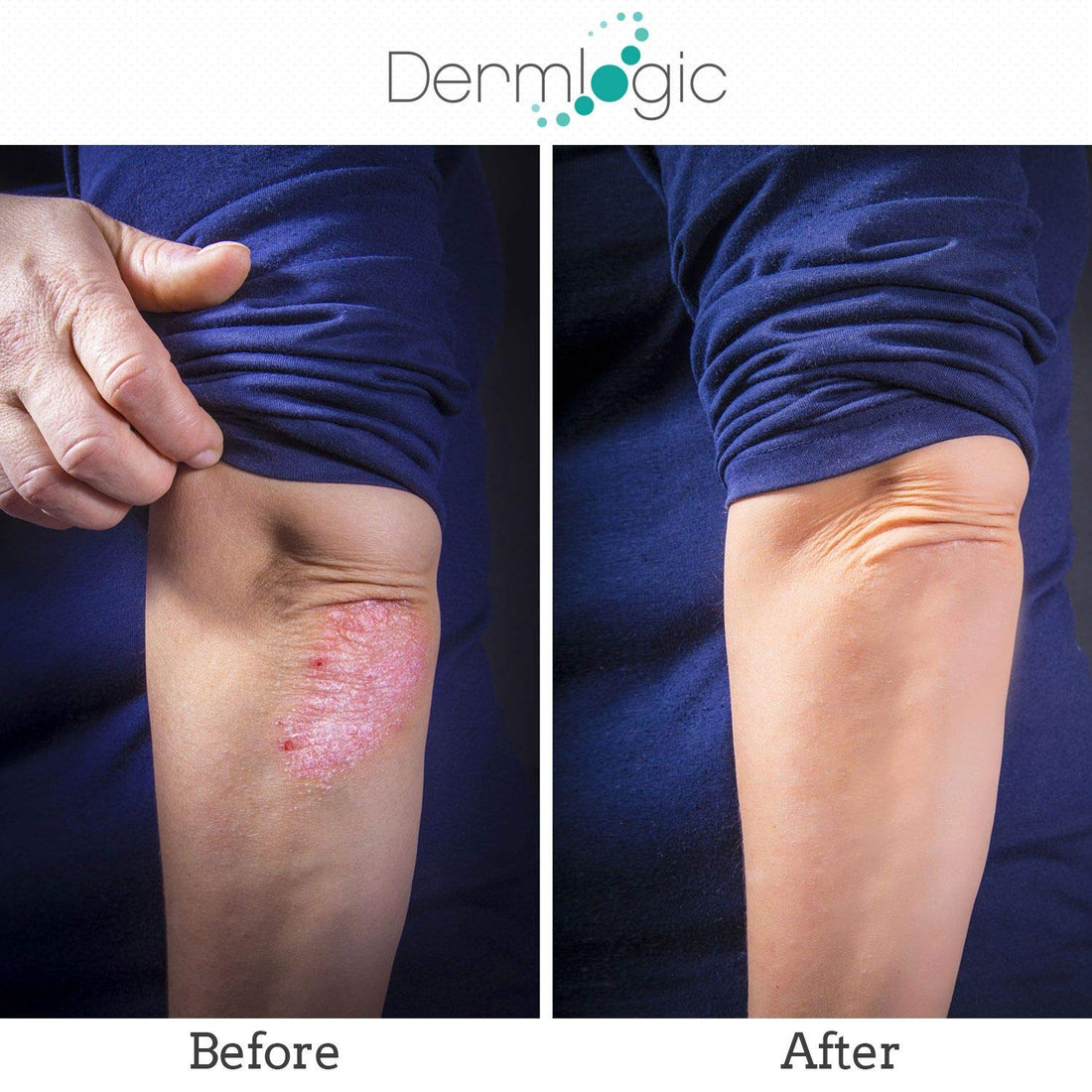 Keratosis Pilaris Treatment- Get Rid of KP, Bumps & Body Acne. 12% Lactic Acid Lotion. Moisturizing Repair Cream Smooths Rough, Dry, Cracked, Bumpy Skin & Redness.