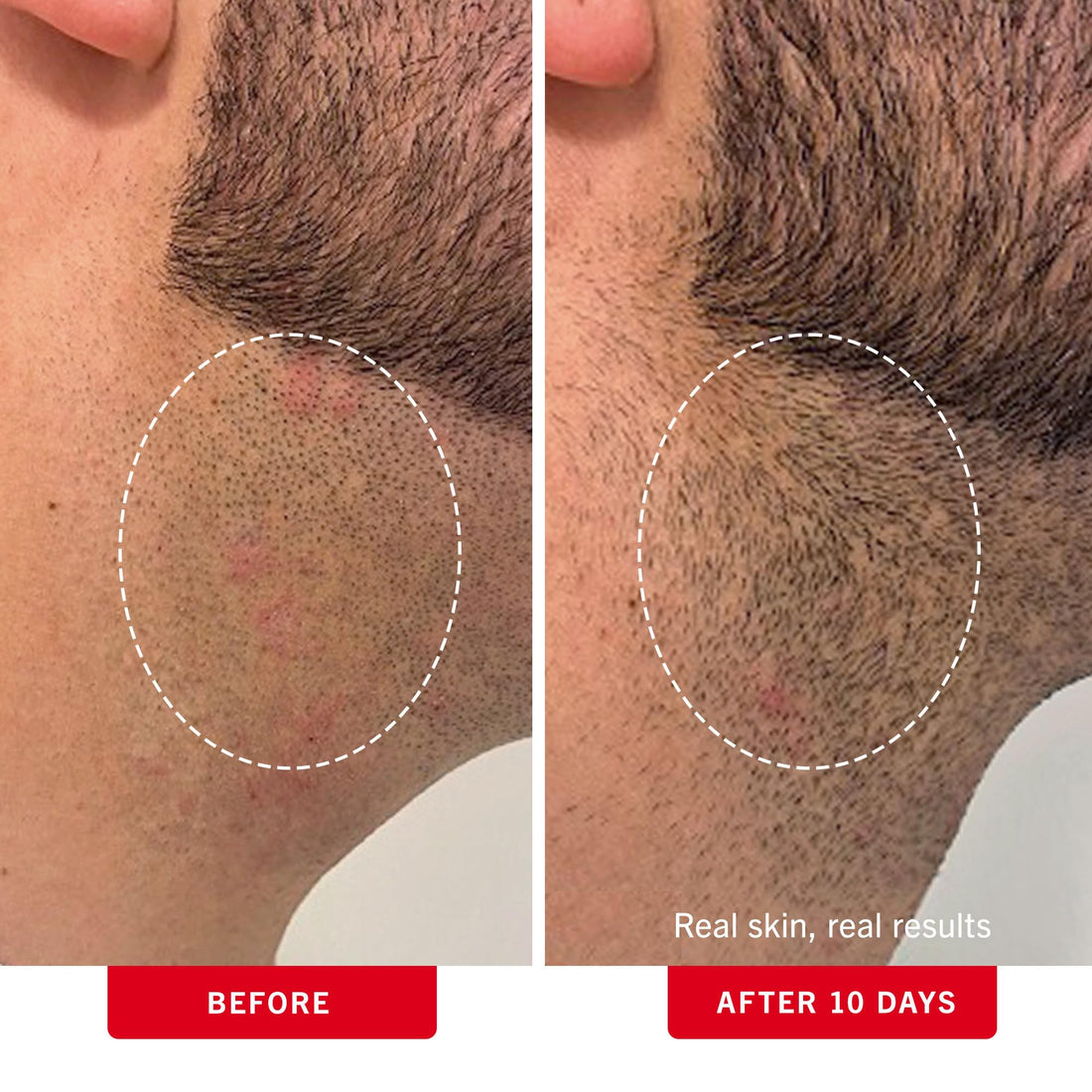 First Aid Beauty - Ingrown Hair Pads with BHA + AHA - Aftershave Treatment Pads to Help Prevent Razor Bumps for Men & Women - Exfoliate Underarms & Bikini Area - Compostable for Daily Use - 60 Pads