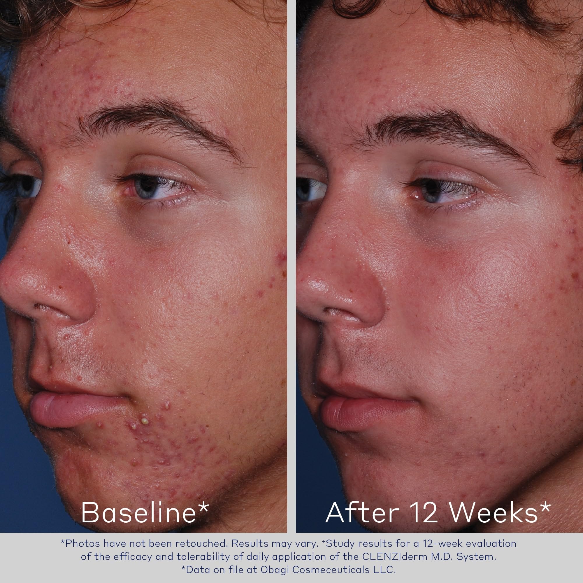 Obagi Medical CLENZIderm M.D. Pore Therapy Acne Treatment, 2% Salicylic Acid Facial Toner for Oily Acne Prone Skin, 5 Fl Oz, Pack of 2