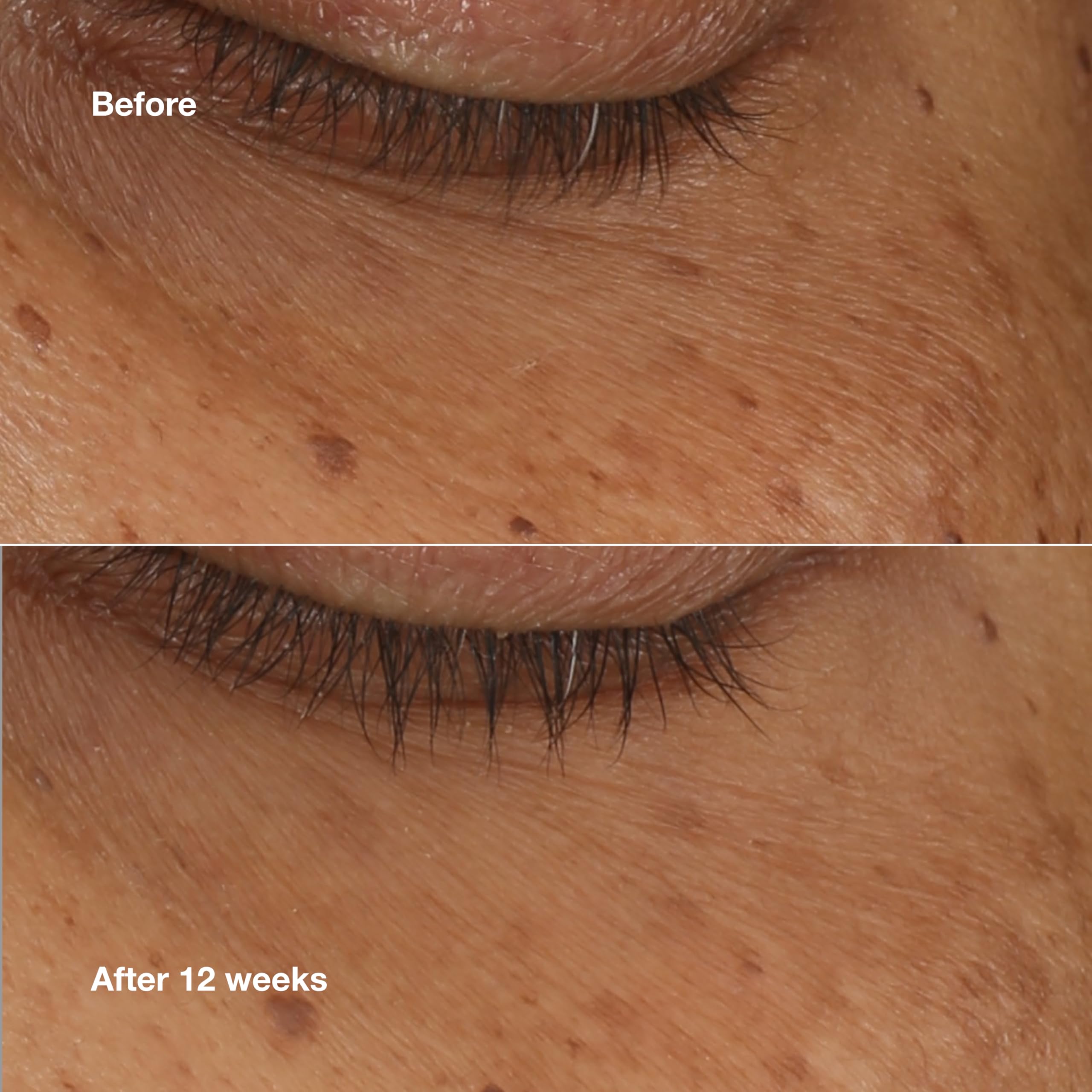 Clinique All About Eyes Brightening Serum Concentrate With Vitamin C, Hyaluronic Acid + Retinol | Hydrating + Reduces Dark Circles, 0.34 Fl Oz