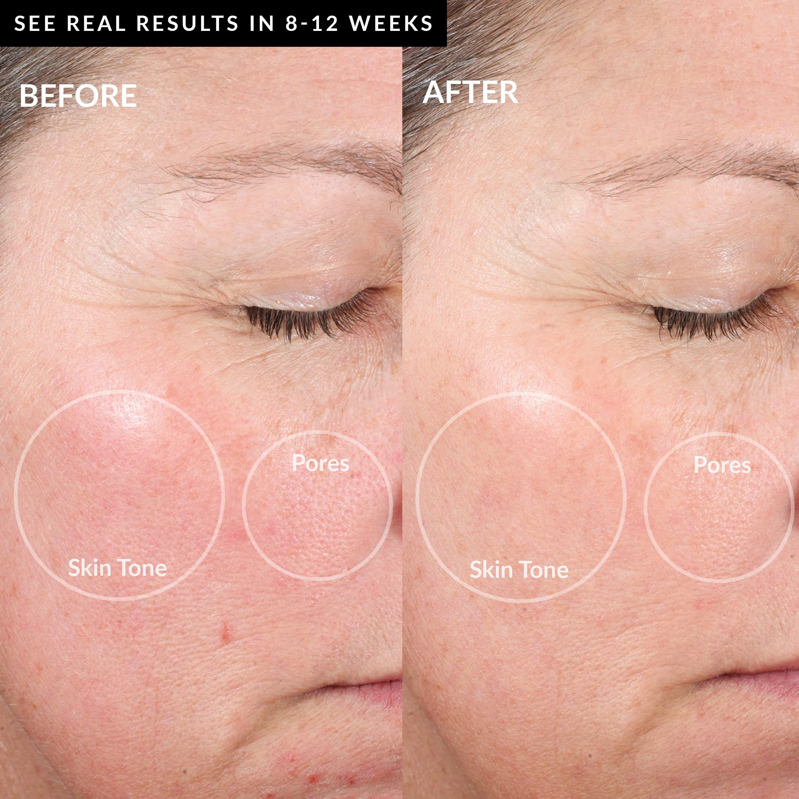 PMD Personal Microderm Elite Pro - Revolutionary At-Home Microdermabrasion Device - Black