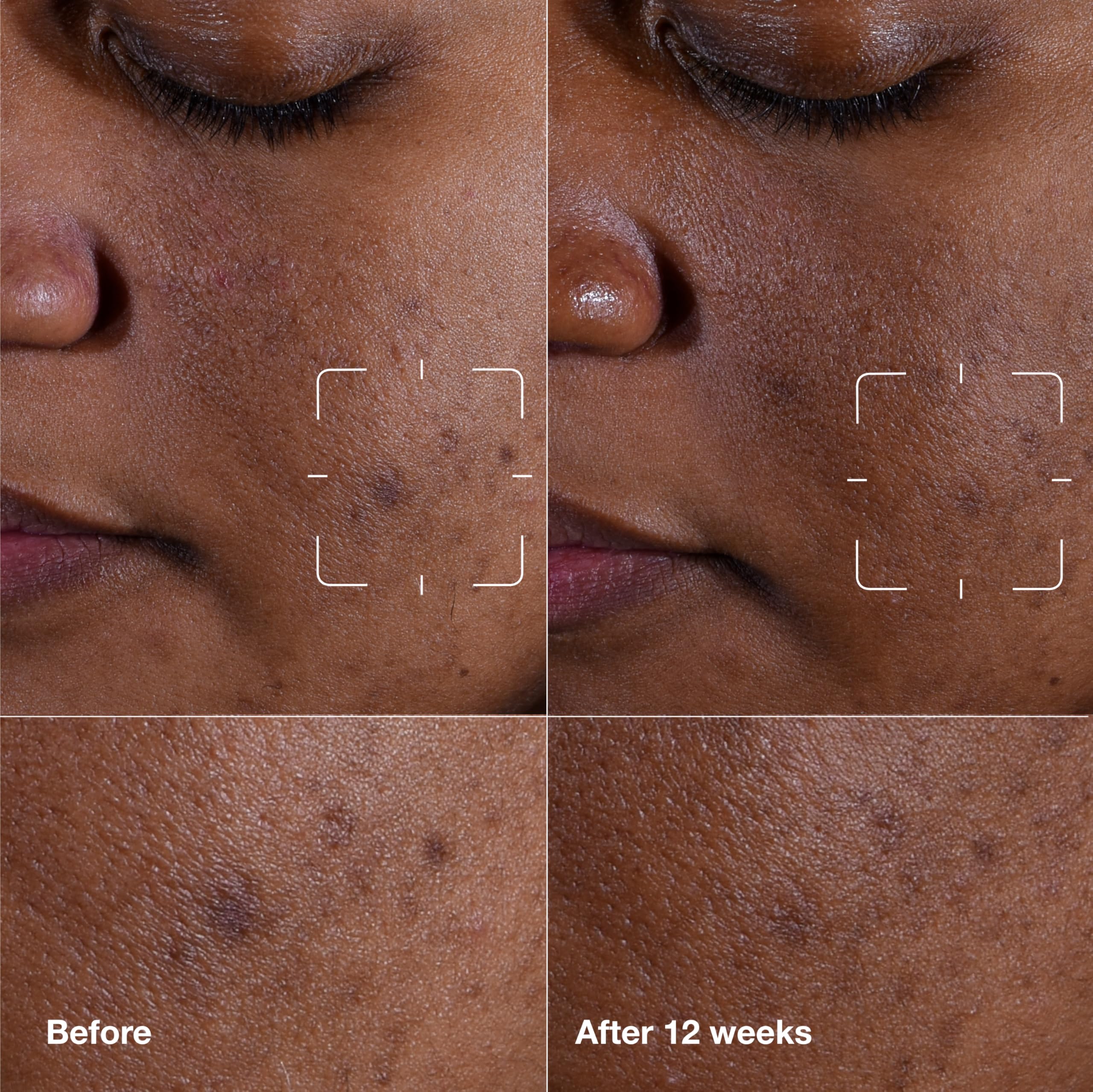 Clinique Even Better Clinical Dark Spot Clearing Serum With Vitamin C | Brightening + Soothing, 1 Fl Oz