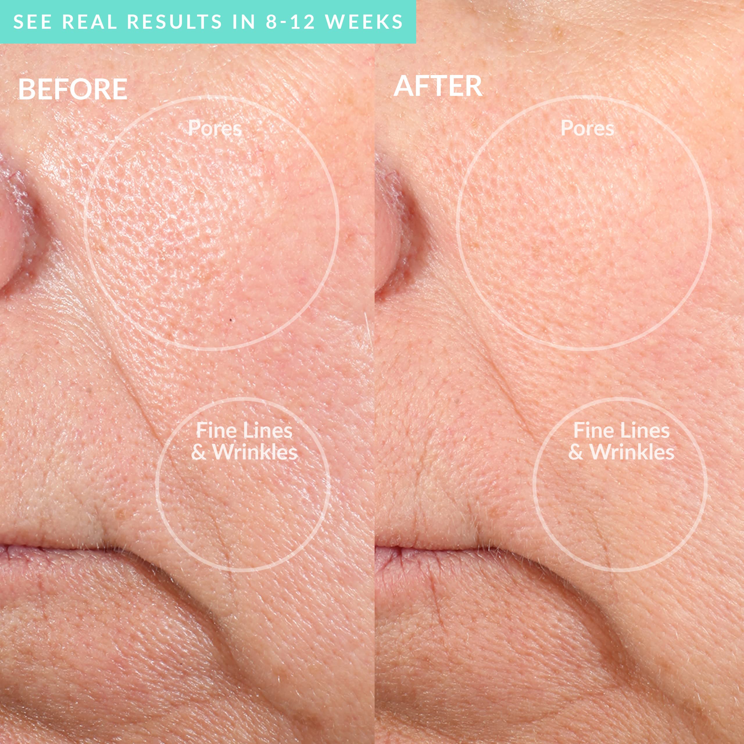 PMD Personal Microderm PRO (Teal)