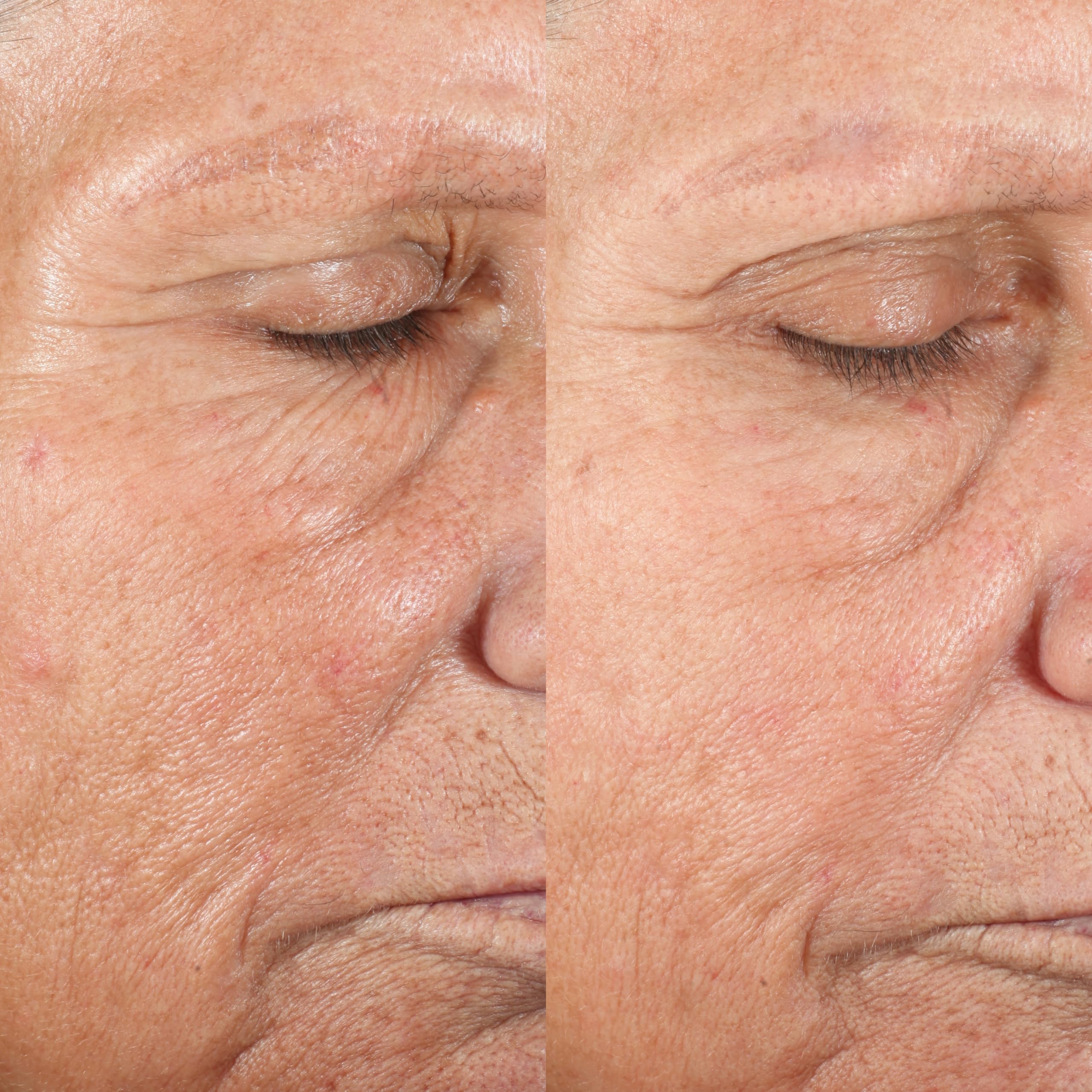 PMD Personal Microderm Classic