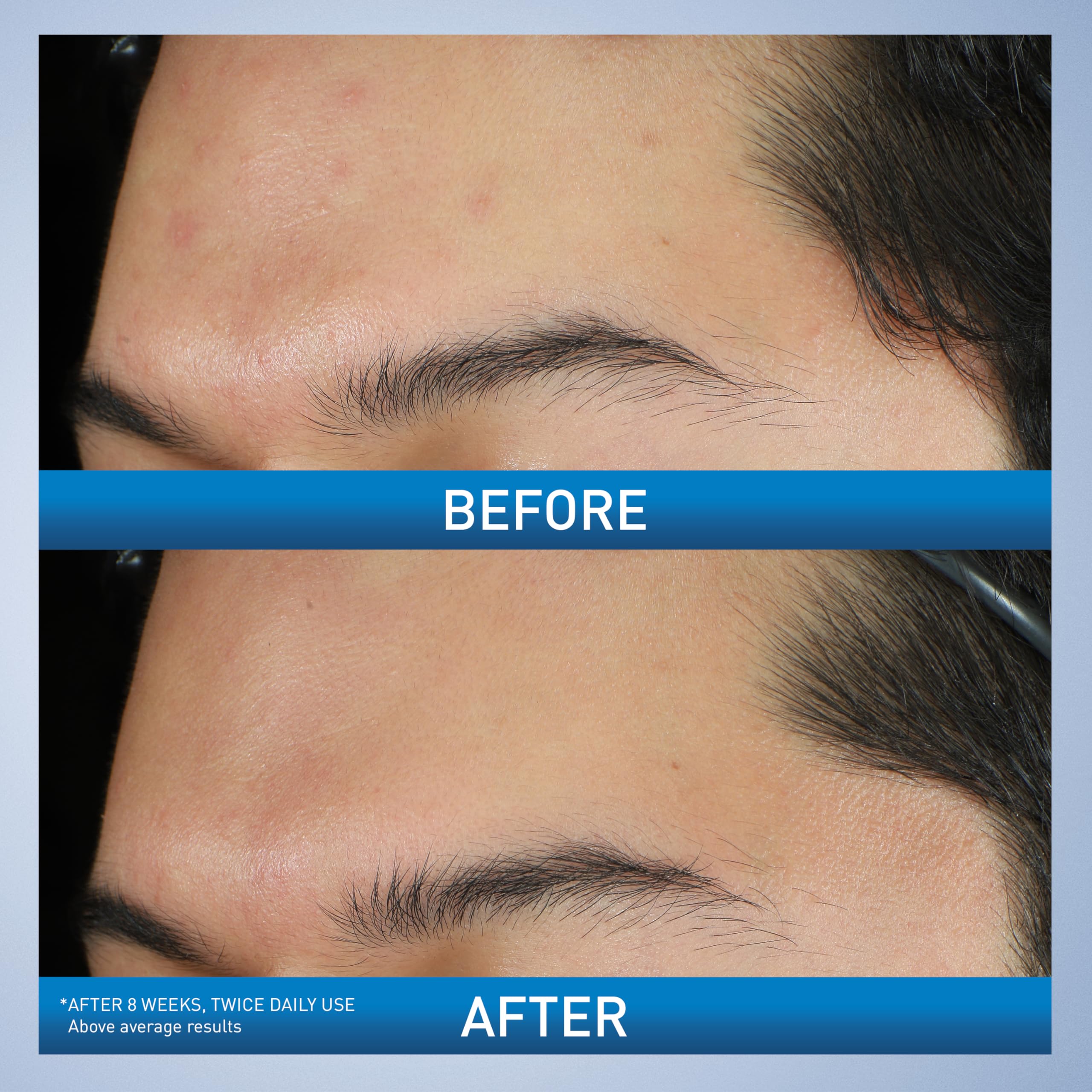 CeraVe Acne Foaming Cream Wash, Gentle Face and Body Cleanser with Benzoyl Peroxide 10%, Hyaluronic Acid, and Niacinamide, 10% Benzoyl Peroxide Treatment Clears Pimples and Blackheads 5 Oz