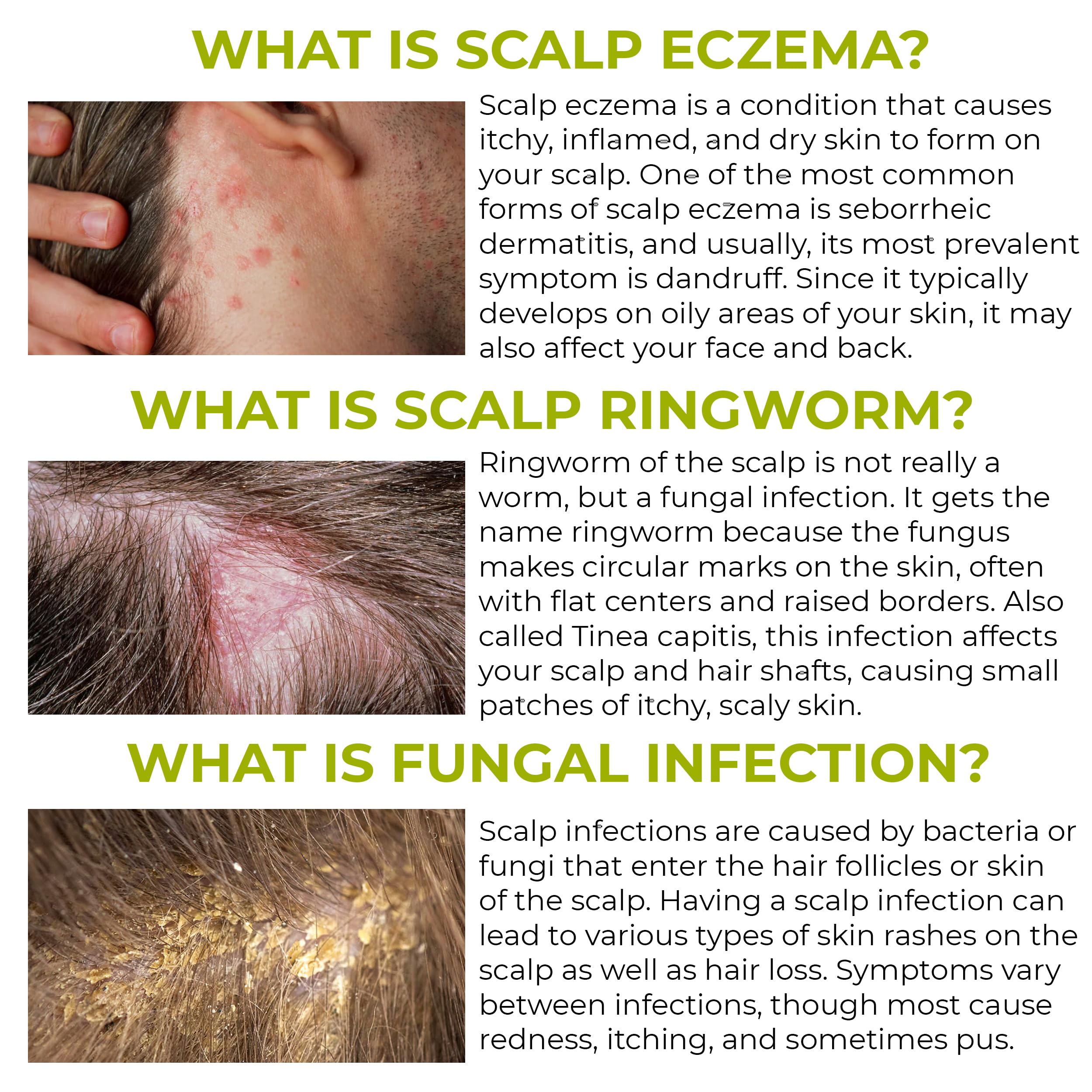 Anti Fungal Folliculitis Shampoo | Relief for Seborrheic Dermatitis, Scalp Psoriasis & Dandruff | Soothes Itchy, Dry Scalp | Cleanses, Exfoliates & Removes Build-Up