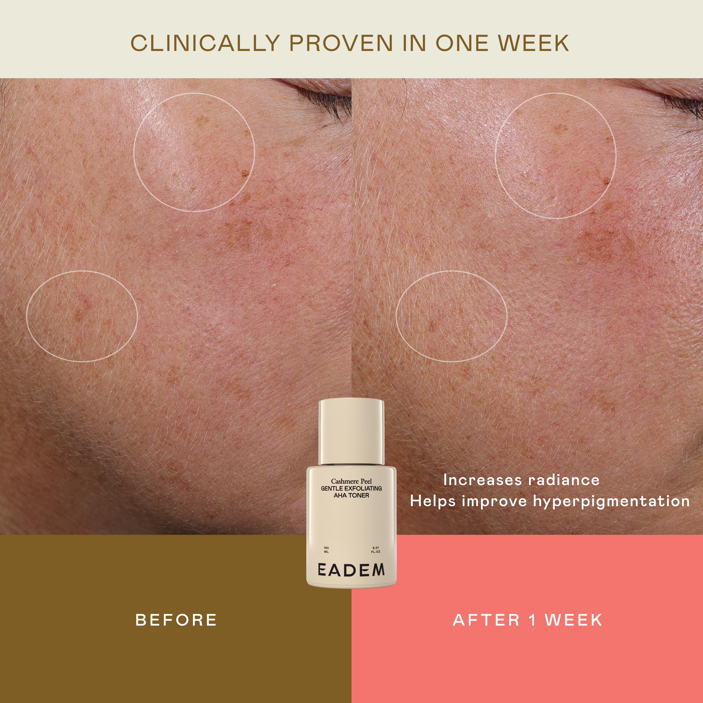 EADEM Gentle Exfoliating AHA & PHA Toner, Exfoliating Face Serum with Tranexamic Acid, AHA Exfoliant & Pore Minimizer for Face and Body, Acne Spot Serum, 5.0 oz, Cashmere Peel