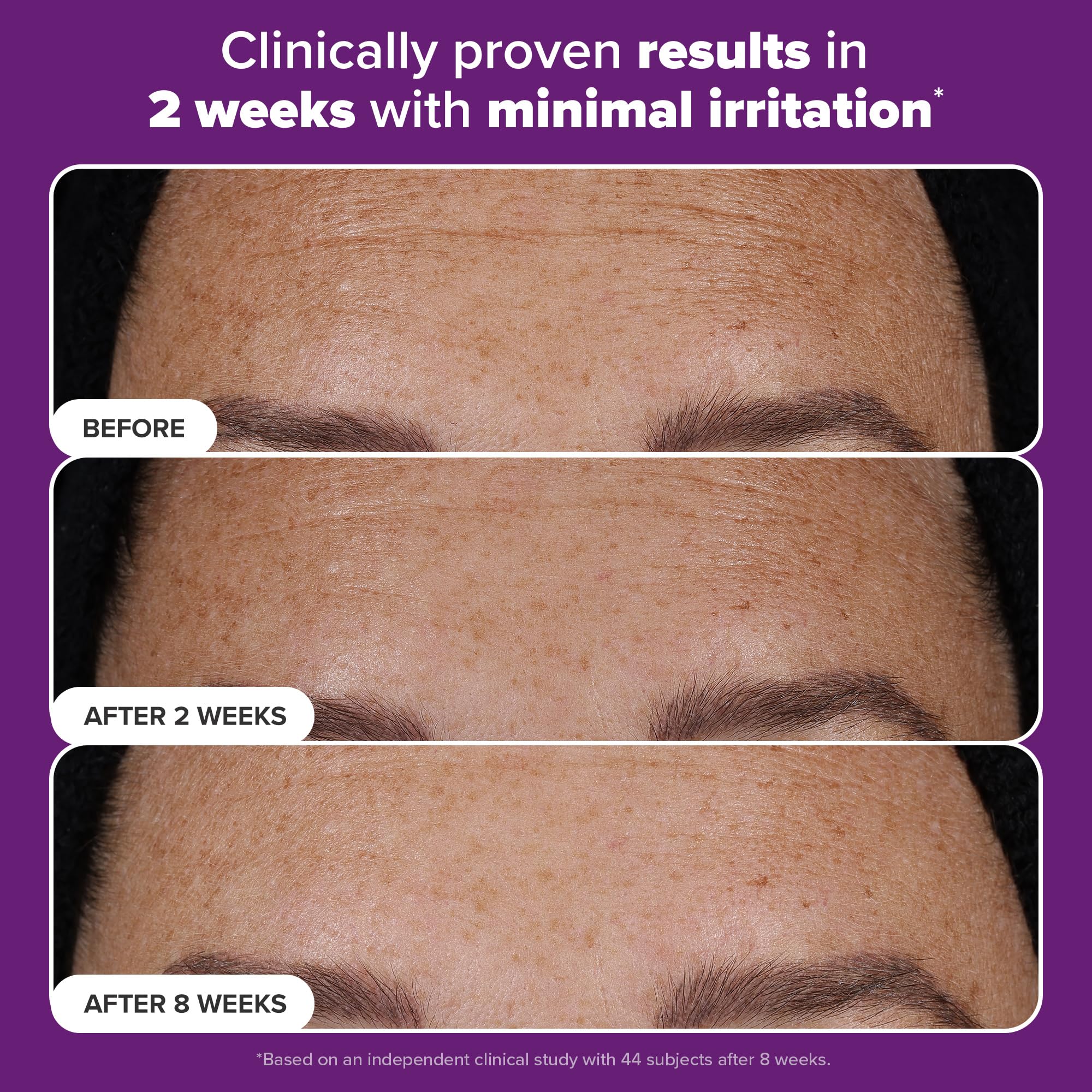 Paula’s Choice Pro Retinaldehyde Dual-Retinoid Advanced Treatment, High Potency Anti-Aging Serum for Breakout-Prone Skin, Radiance & Rough, Bumpy Texture, Fragrance-Free, 1 Fl. Oz.