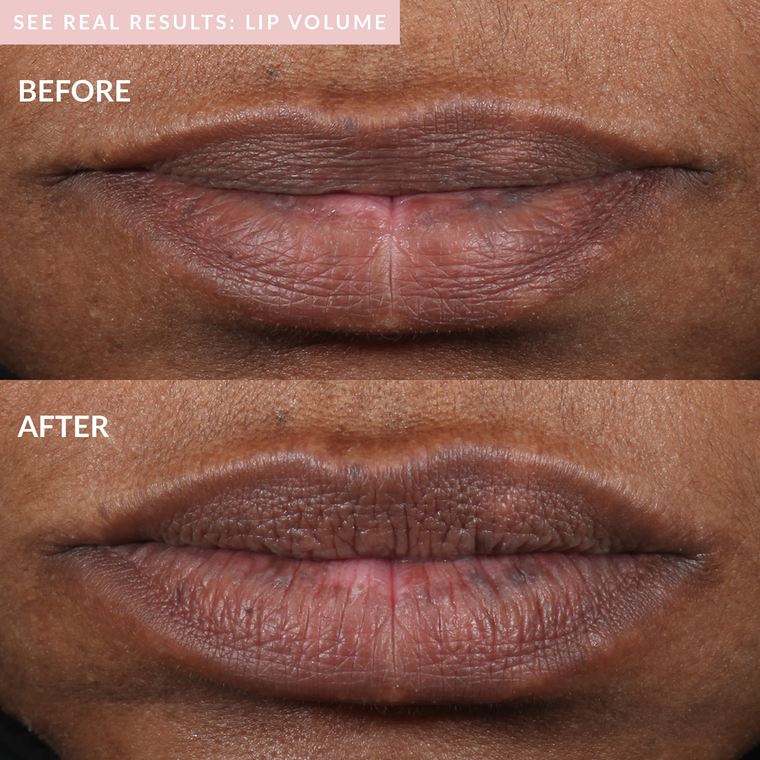 PMD Kiss Lip Plumping System - Smart Anti-Aging Lip Plumping Treatment - Pulsating Vacuum Technology for Fuller, More Youthful Lips