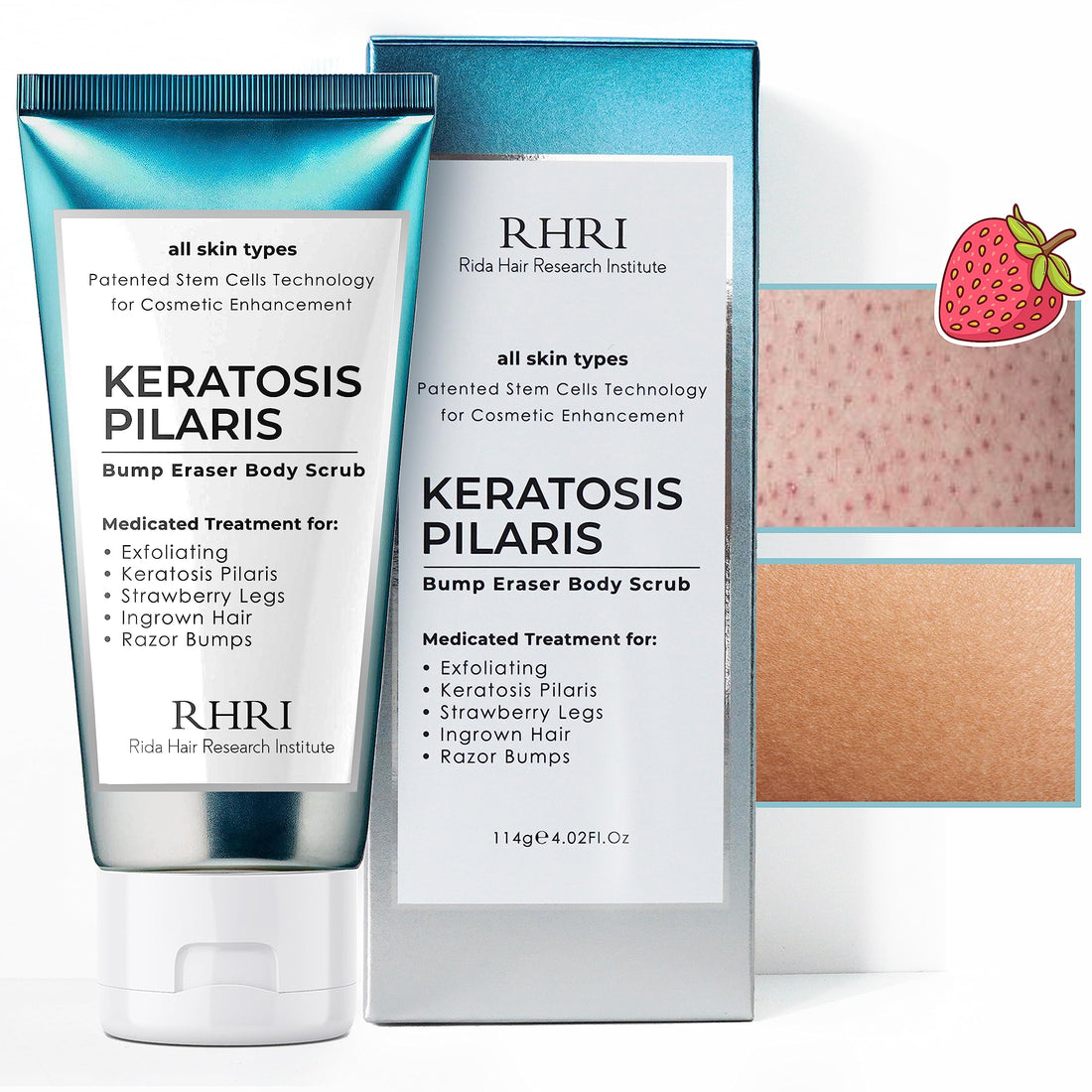 KP Bump Eraser Body Scrub, Keratosis Pilaris Treatment, Strawberry Legs Treatment for Women, Bump Eraser Body Scrub