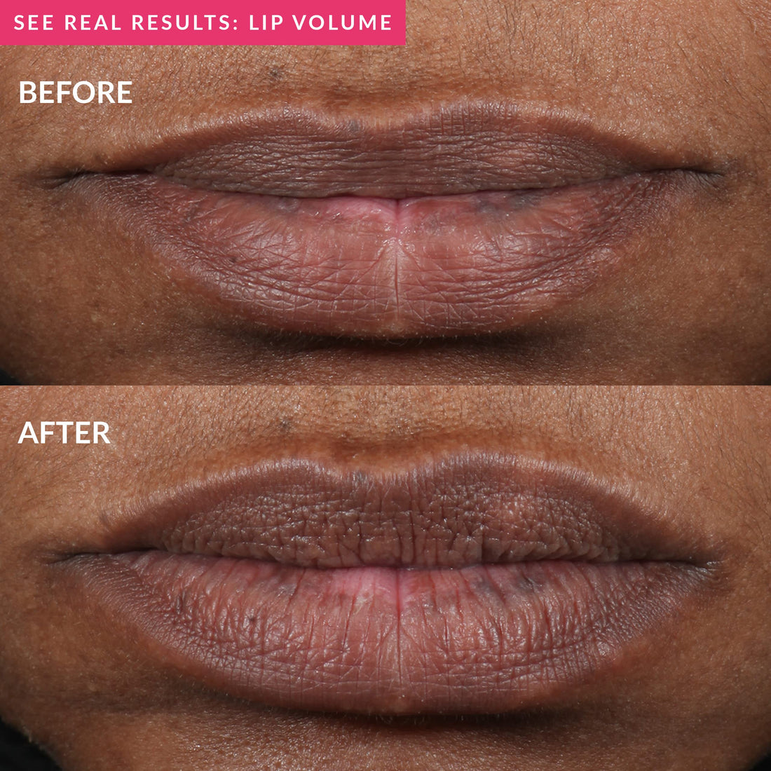 PMD Kiss Lip Plumping System - Smart Anti-Aging Lip Plumping Treatment - Pulsating Vacuum Technology for Fuller, More Youthful Lips